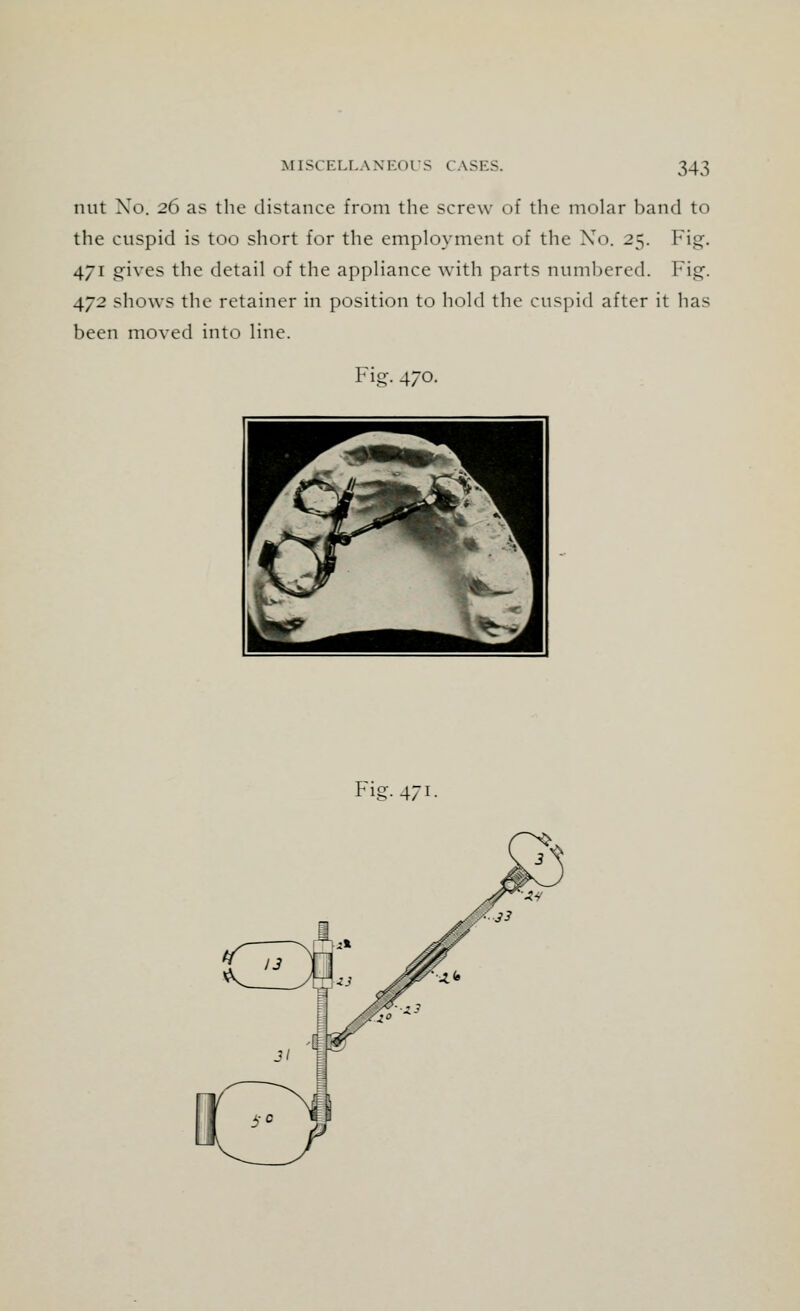 nut No. 26 as the distance from the screw of the molar band to the cuspid is too short for the employment of the Xo. 25. Fig. 471 gives the detail of the appliance with parts numbered. Fig. 472 shows the retainer in position to hold the cuspid after it has been moved into line. Fig. 470. Fig-4/~i-