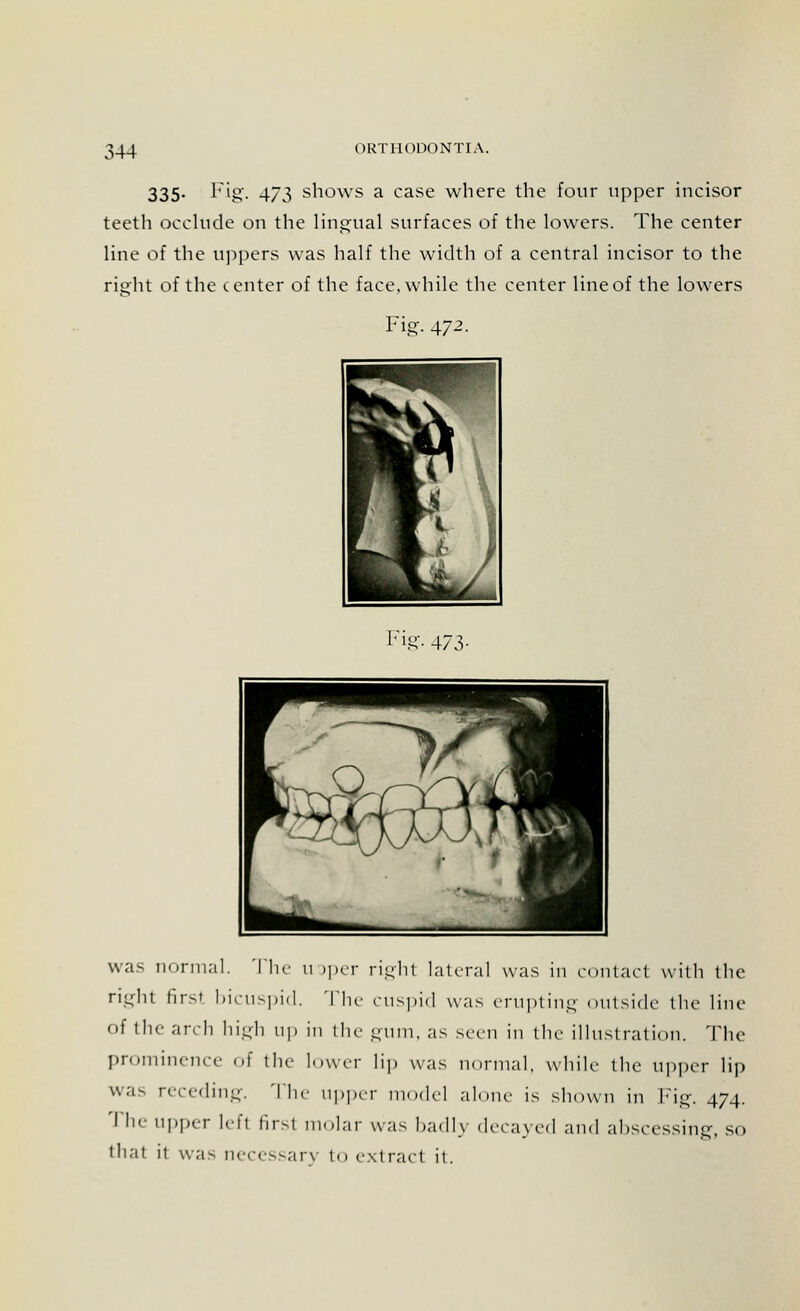 335- Fig- 473 shows a case where the four upper incisor teeth occlude on the lingual surfaces of the lowers. The center line of the uppers was half the width of a central incisor to the right of the center of the face, while the center line of the lowers Fig. 472. Fig- 473- was normal. The u >per right lateral was in contact with the right first bicuspid. The cuspid was erupting outside the line of the arch high up in the gum, as seen in the illustration. The prominence of the lower lip was normal, while the Upper lip was receding. 'I In- upper model alone is shown in Fig. 474. '' he upper lefl firsl molar was badly decayed and abscessing, so that it was necessary to extract it.