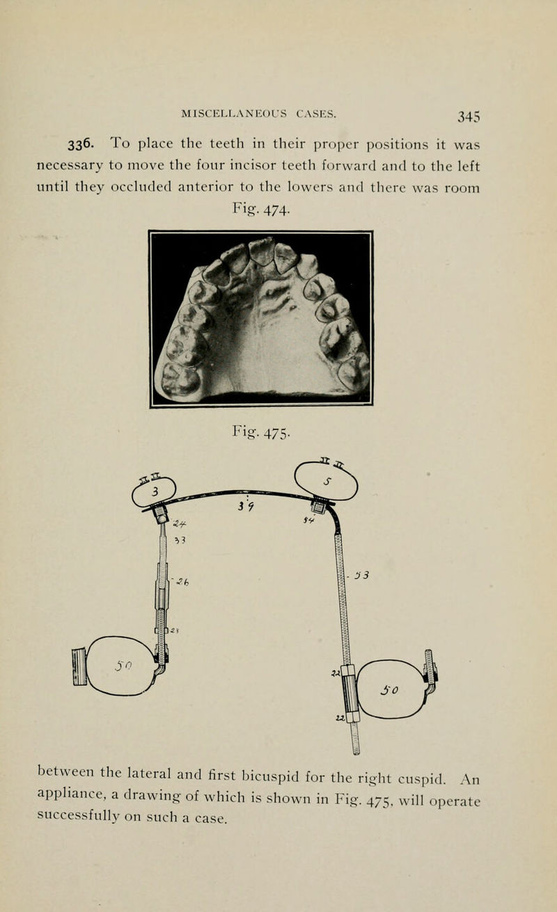 MlSCKLLANKOl'S (ASICS. 336. To place the teeth in their proper positions it was necessary to move the four incisor teeth forward and to the left until they occluded anterior to the lowers and there was room Fig. 474. M W 1 W ^—i :—11 Fig- 475- between the lateral and first bicuspid for the right cuspid. An appliance, a drawing of which is shown in Fig. 47s< wjn operate successfully on such a case.