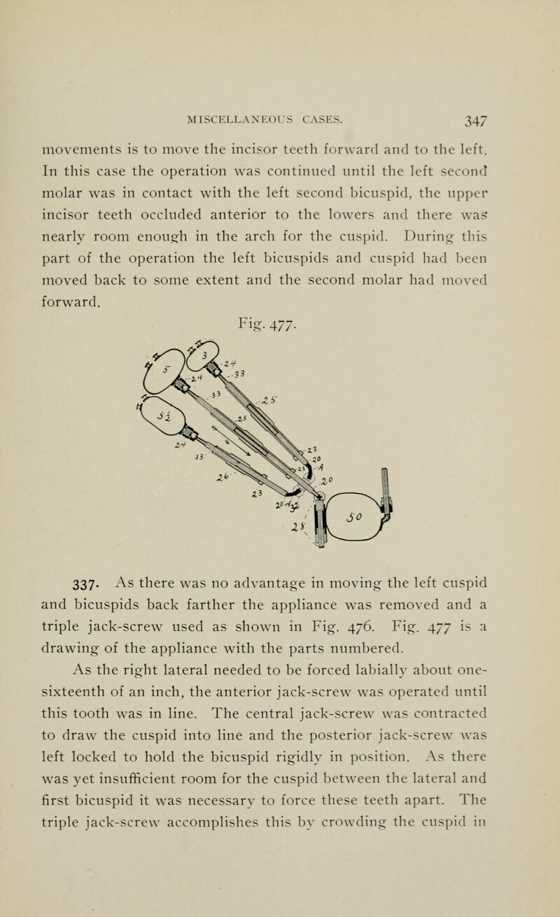 movements is to move the incisor teeth forward and to the left. In this case the operation was continued until the left second molar was in contact with the left second bicuspid, the upper incisor teeth occluded anterior to the lowers and there was* nearly room enough in the arch for the cuspid. During this part of the operation the left bicuspids and cuspid had been moved back to some extent and the second molar had moved forward. Fig- 477- 337. As there was no advantage in moving the left cuspid and bicuspids back farther the appliance was removed and a triple jack-screw used as shown in Fig. 476. Fig. 477 is a drawing of the appliance with the parts numbered. As the right lateral needed to be forced labially about one- sixteenth of an inch, the anterior jack-screw was operated until this tooth was in line. The central jack-screw was contracted to draw the cuspid into line and the posterior jack-screw was left locked to hold the bicuspid rigidly in position. As there was yet insufficient room for the cuspid between the lateral and first bicuspid it was necessarv to force these teeth apart. The triple jack-screw accomplishes this by crowding the cuspid in
