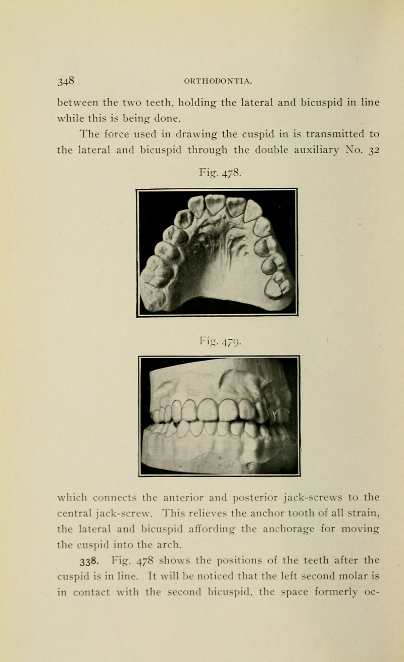 between the two teeth, holding the lateral and bicuspid in line while this is being done. The force used in drawing the cuspid in is transmitted to the lateral and bicuspid through the double auxiliary Xo. 32 Fig. 478. Fig. 479- which connects the anterior and posterior jack-screws to the central jack-screw. This relieves the anchor tooth of all strain. the lateral and bicuspid affording tin- anchorage for moving the cuspid into the arch. 338. Fig. 478 shows the positions of the teeth after the cuspid is in line. It will be noticed that the left second molar is in contact with the second bicuspid, the space former!\ oc-