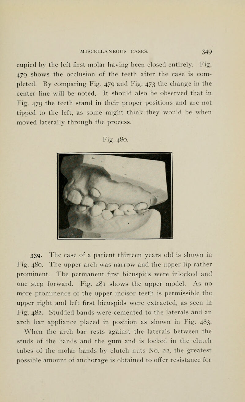 cupied by the left first molar having been closed entirely. Fig. 479 shows the occlusion of the teeth after the case is com- pleted. By comparing Fig. 479 and Fig. 473 the change in the center line will be noted. It should also be observed that in Fig. 479 the teeth stand in their proper positions and are not tipped to the left, as some might think they would be when moved laterally through the process. Fig. 480. 339. The case of a patient thirteen years old is shown in Fig. 480. The upper arch was narrow and the upper lip rather prominent. The permanent first bicuspids were inlocked and one step forward. Fig. 481 shows the upper model. As no more prominence of the upper incisor teeth is permissible the upper right and left first bicuspids were extracted, as seen in Fig. 482. Studded bands were cemented to the laterals and an arch bar appliance placed in position as shown in Fig. 483. When the arch bar rests against the laterals between the studs of the bands and the gum and is locked in the clutch tubes of the molar bands by clutch nuts Xo. 22, the greatest possible amount of anchorage is obtained to offer resistance for
