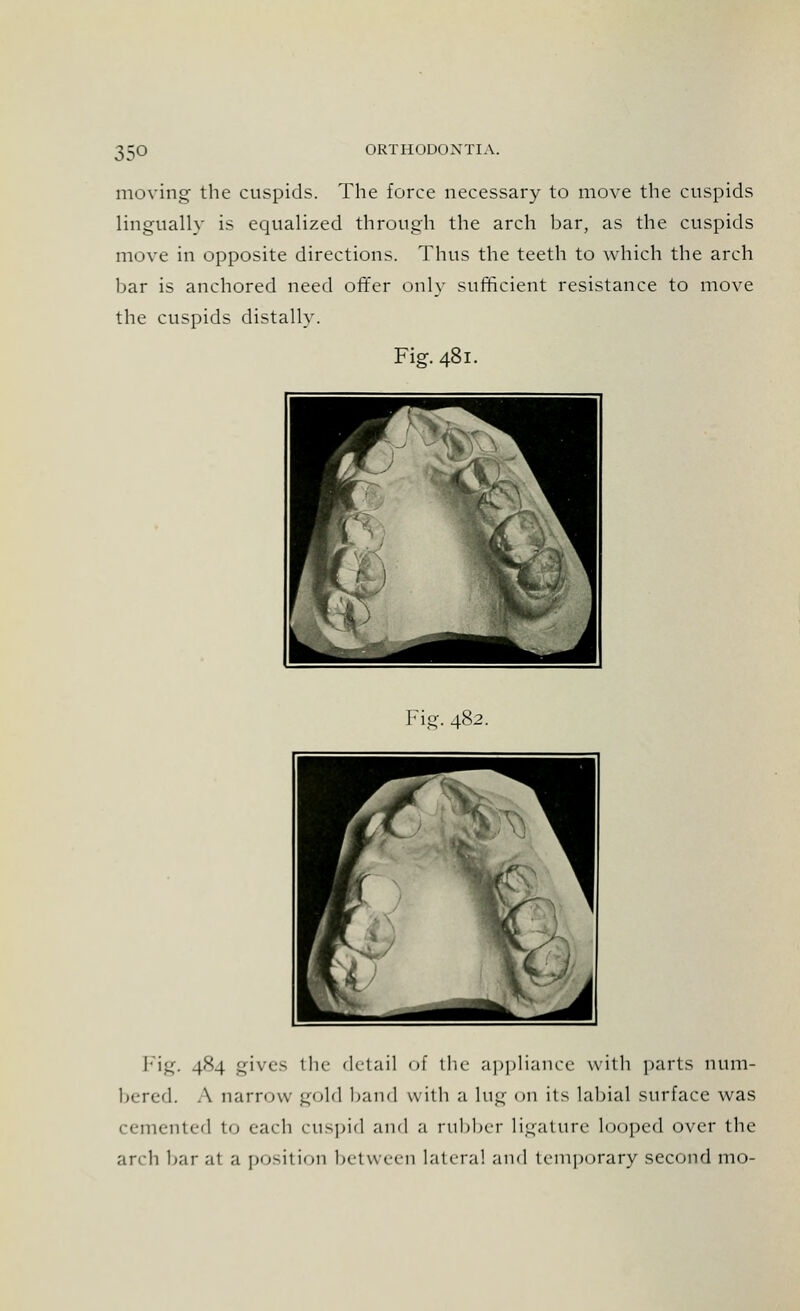 moving the cuspids. The force necessary to move the cuspids lingually is equalized through the arch bar, as the cuspids move in opposite directions. Thus the teeth to which the arch bar is anchored need offer only sufficient resistance to move the cuspids distally. Fig. 481. ■ ■ ^ Bfr ^l5v; Br * i ^B Ft \ 1 L_^ ^^^mm ^^^^^^ Fig. 482. Fig. 484 gives the detail of the appliance with parts num- bered. A narrow gold band with a lug on its labial surface was cemented to each cuspid and a rubber ligature looped over the arch bar at a position between lateral and temporary second mo-