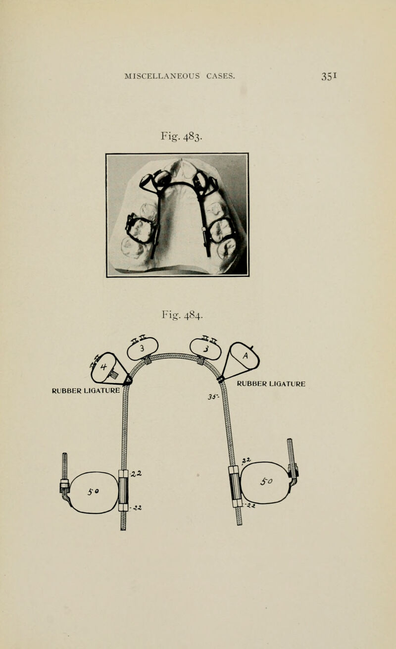 Fig. 483. Fig. 484. RUBBER LIGATURE I RUBBER LIGATURE