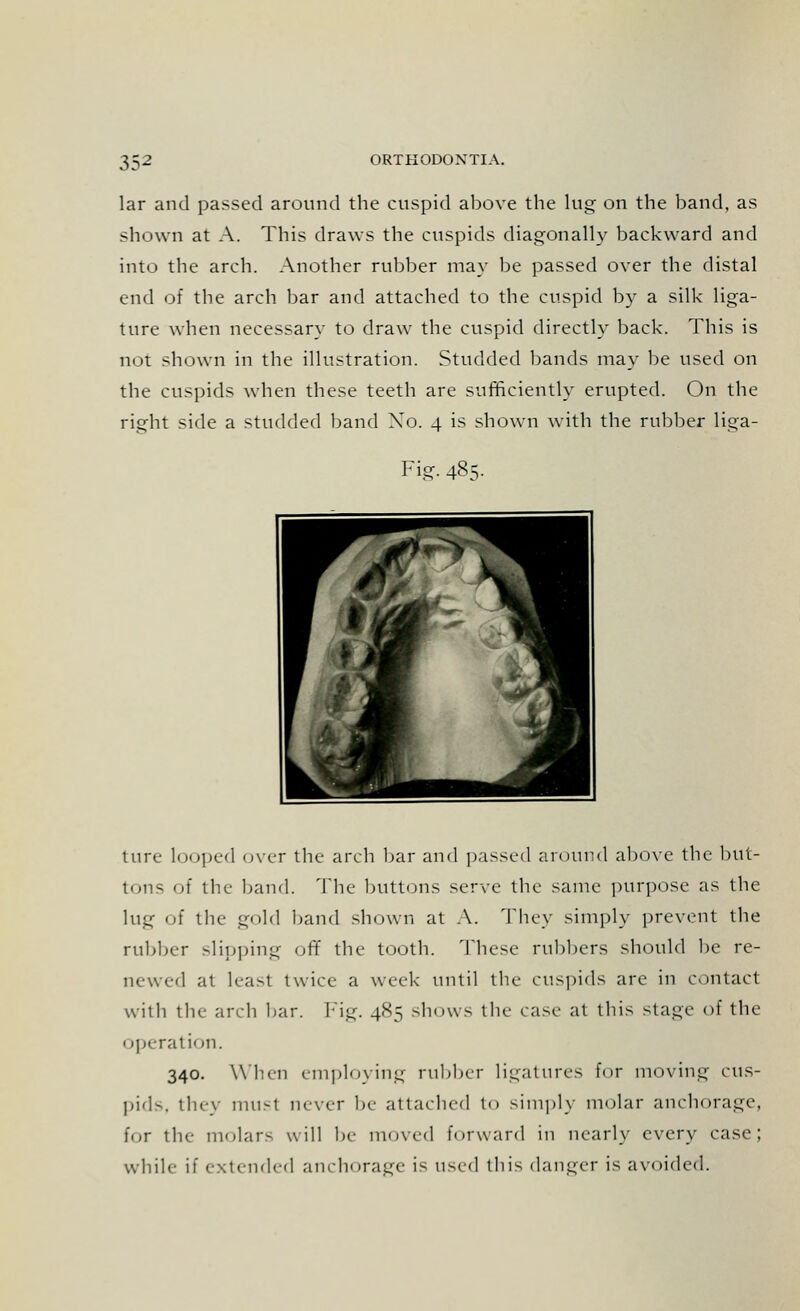 lar and passed around the cuspid above the lug on the band, as shown at A. This draws the cuspids diagonally backward and into the arch. Another rubber may be passed over the distal end of the arch bar and attached to the cuspid by a silk liga- ture when necessary to draw the cuspid directly back. This is not shown in the illustration. Studded bands may be used on the cuspids when these teeth are sufficiently erupted. On the right side a studded band Xo. 4 is shown with the rubber liga- Fig. 485. ture looped over the arch bar and passed around above the but- tons of the band. The buttons serve the same purpose as the lug of the gold band shown at A. They simply prevent the rubber slipping off the tooth. These rubbers should be re- newed at least twice a week until the cuspids are in contact with the arch bar. Fig. 485 shows the case at this stage of the o],(-ration. 340. When employing rubber ligatures for moving cus- pids, tiny must never be attached to simply molar anchorage, for the molar- will be moved forward in nearly every case; while if extended anchorage i1- \]^^'\ this danger is avoided.