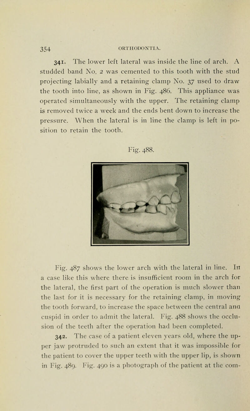 341. The lower left lateral was inside the line of arch. A Studded band No. 2 was cemented to this tooth with the stud projecting labially and a retaining clamp Xo. 37 used to draw the tooth into line, as shown in Fig. 486. This appliance was operated simultaneously with the upper. The retaining- clamp is removed twice a week and the ends bent down to increase the pressure. When the lateral is in line the clamp is left in po- sition to retain the tooth. Fig. 488. Fig. 4S7 shows the lower arch with the lateral in line. In a case like this where there is insufficient room in the arch for the lateral, the first part of the operation is much slower than the lasl for it is necessary for the retaining clamp, in moving the tooth forward, to increase the space between the central and CUSpid in order to admit tile lateral. Fig. 488 shows the occlu- sion of the teeth after the operation had been completed. 342. The case of a patienl eleven years old, where the up- per jaw protruded to such an extent that it was impossible for the patient to rover the upper teeth with the upper lip, is shown in Fig. 4^'j- Fig. 490 i1-- a photograph of the patient at the com-