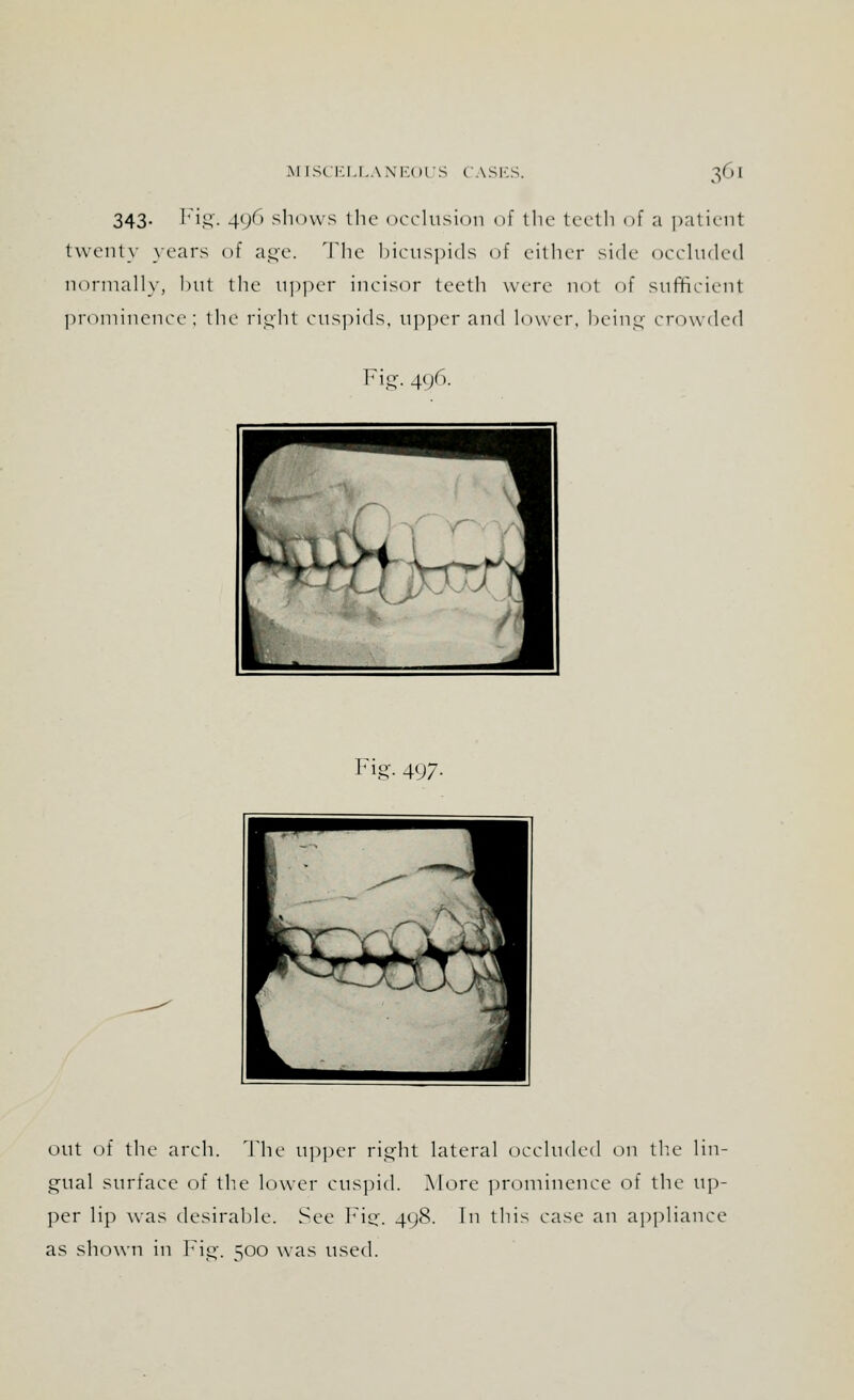 343. Fig. 496 shows the occlusion of the teeth of a patient twenty years of age. The bicuspids of either side occluded normally, but the upper incisor teeth were not of sufficient prominence; the right cuspids, upper and lower, being crowded Fig. 496. Fig. 497. out of the arch. The upper right lateral occluded on the lin- gual surface of the lower cuspid. More prominence of the up- per lip was desirable. See Fig-. 498. In this case an appliance as shown in Fig'. 500 was used.