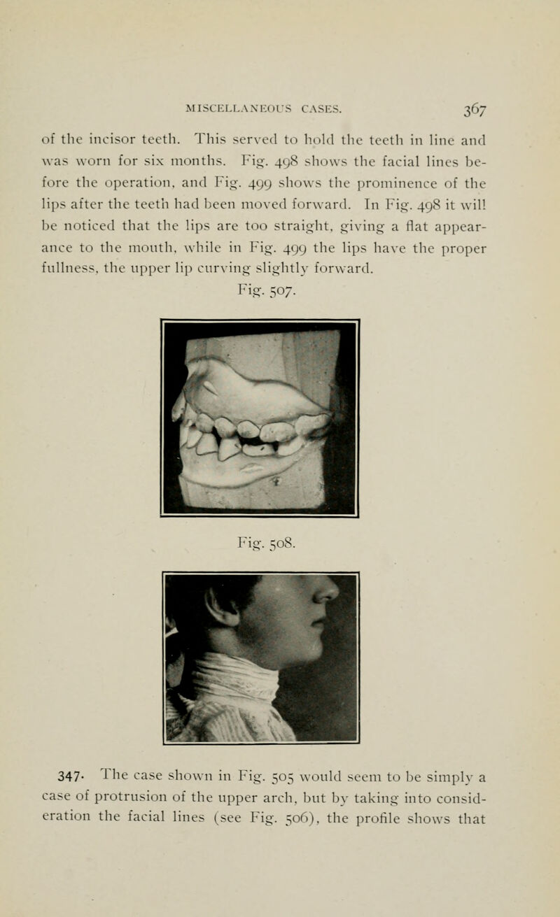 of the incisor teeth. This served to hold the teeth in line and was worn for six months. Fig. 408 shows the facial lines he- Fore the operation, and Fig. 400 shows the prominence of the lips after the teeth had been moved forward. In Fig. 498 it will he noticed that the lips are too straight, giving a flat appear- ance to the month, while in Fig. 400 the lips have the proper fullness, the upper lip curving slightly forward. Fig. 507. Fig. 508. 347. The case shown in Fig. 505 would seem to he simple a case of protrnsion of the upper arch, but by taking into consid- eration the facial lines (see Fig. 506). the profile shows that