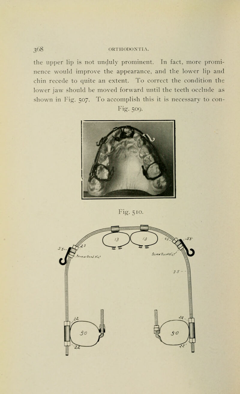 the tipper lip is not unduly prominent, hi fact, more promi- nence would improve the appearance, and the lower lip and chin recede to quite an extent. To correct the condition the lower jaw should be moved forward until the teeth occlude as shown in Fig. 507. To accomplish this it is necessary to con- Fig- 5°{)-