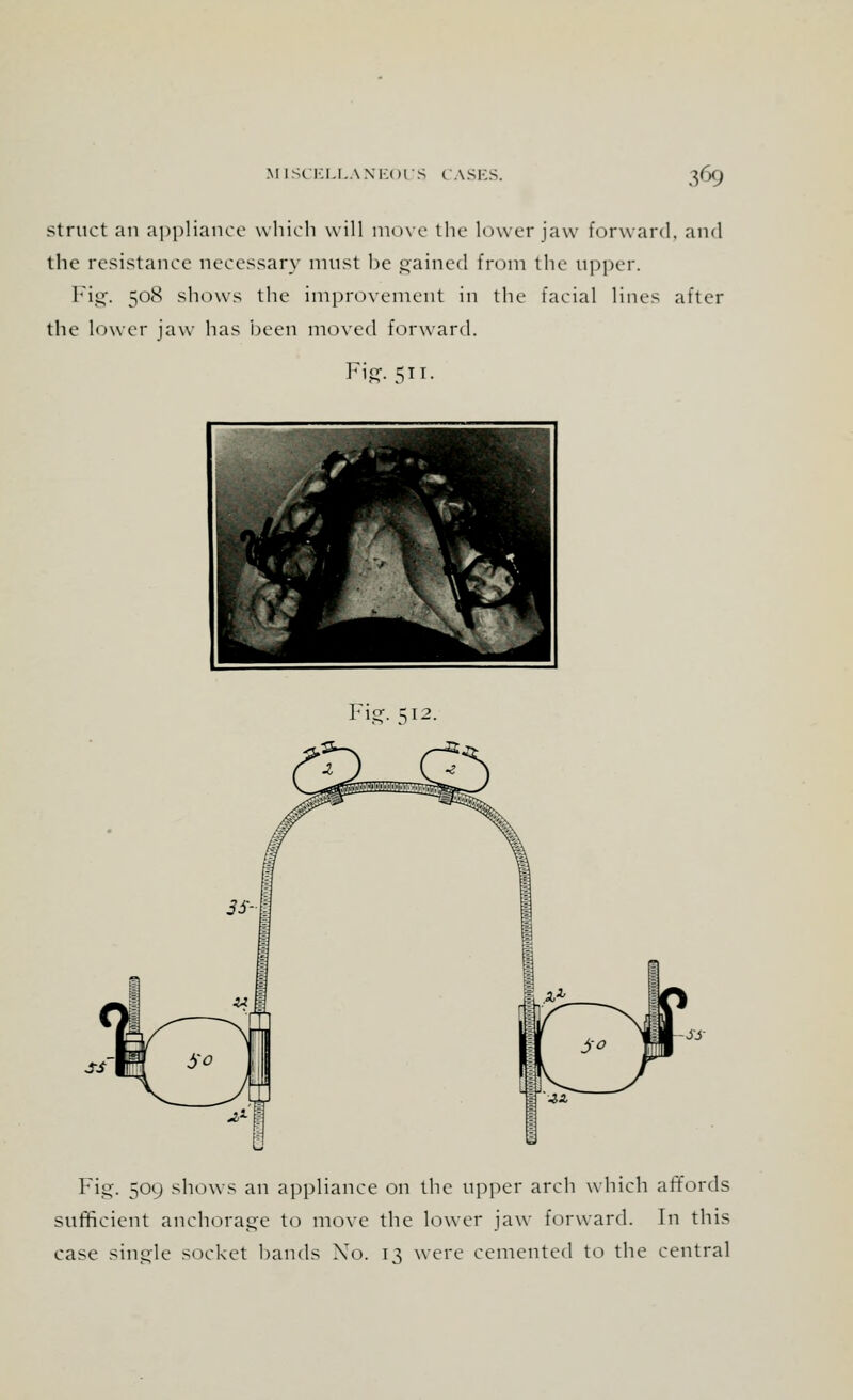 struct an appliance which will move the lower jaw forward, and the resistance necessary must be gained from the upper. Fig. 508 shows the improvement in the facial lines after the lower jaw has been moved forward. Fig. 511. Fisr. ^12. Fig. 509 shows an appliance on the upper arch which affords sufficient anchorage to move the lower jaw forward. In this case single socket bands No. 13 were cemented to the central
