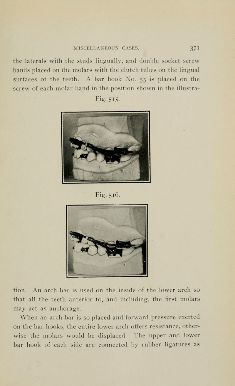 the laterals with the studs lingually, and double socket screw bands placed on the molars with the clutch tubes on the lingual surfaces of the teeth. A bar hook No. 55 is placed on the screw of each molar band in the position shown in the illustra- Fig- 5*5- Fig. 516. tion. An arch bar is used on the inside of the lower arch so that all the teeth anterior to. ami including, the first molars may act as anchorage. When an arch bar is so placed and forward pressure exerted on the bar hooks, the entire lower arch otters resistance, other- wise the molars would be displaced. The upper and lower bar hook of each side are connected by rubber ligatures as