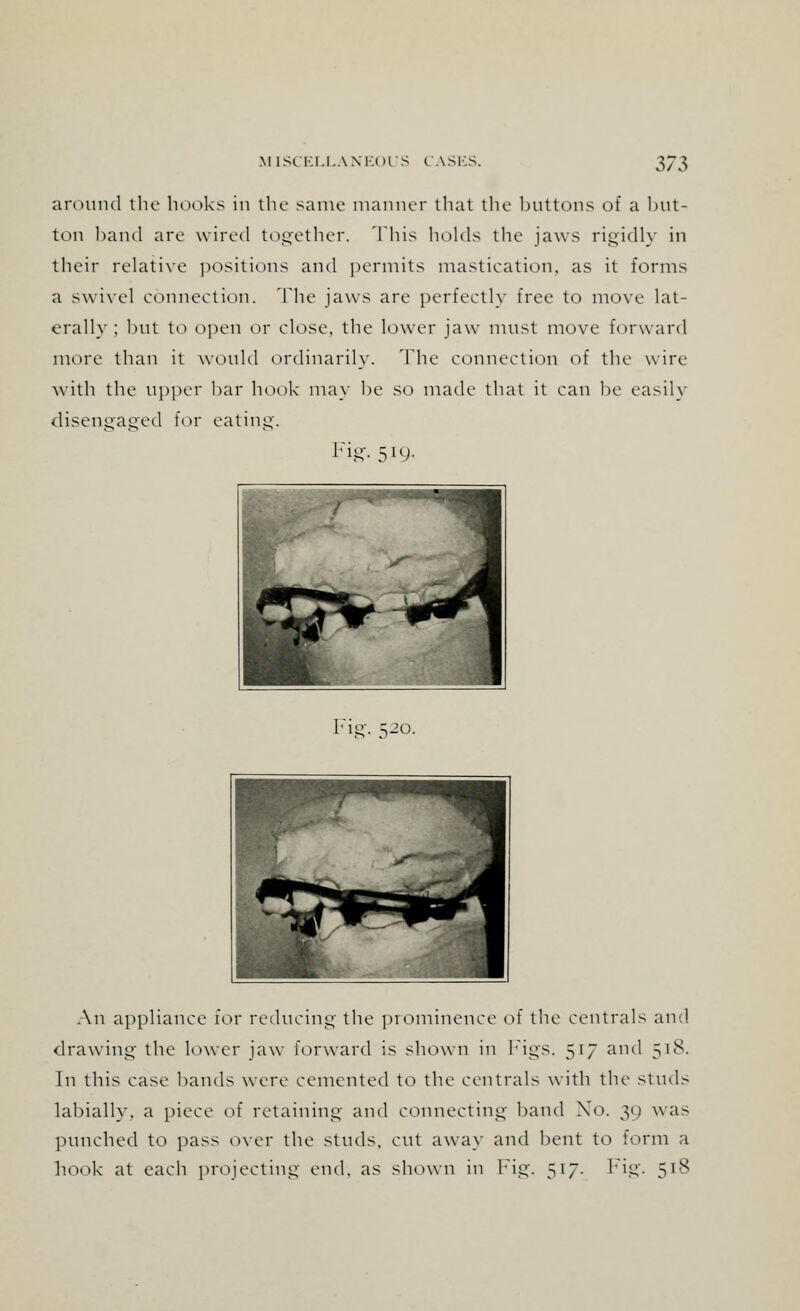 around the hooks in the same manner that the buttons of a but- ton band arc wired together, ddiis holds the jaws rigidly in their relative positions and permits mastication, as it forms a swivel connection. The jaws are perfectly free to move lat- erally ; but to open or close, the lower jaw must move forward more than it would ordinarily, The connection of the wire with the upper bar hook may he so made that it can he easily disengaged for eating. Fig. 519. Fig. 520. An appliance for reducing the prominence of the centrals and drawing the lower jaw forward is shown in Figs. 517 and 518. In this case hands were cemented to the centrals with the studs lahially. a piece of retaining' and connecting hand Xo. 30 was punched to pass over the studs, cut away and bent to form a hook at each projecting end, as shown in Fig. 517. Fig. 518