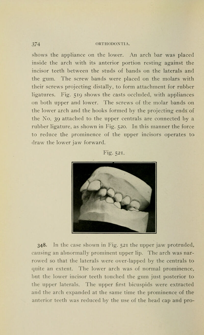 shows the appliance on the lower. An arch bar was placed inside the arch with its anterior portion resting against the incisor teeth between the studs of bands on the laterals and the gum. The screw bands were placed on the molars with their screws projecting distally, to form attachment for rubber ligatures. Fig. 519 shows the casts occluded, with appliances on both upper and lower. The screws of the molar bands on the lower arch and the hooks formed by the projecting ends of the Xo. 39 attached to the upper centrals are connected by a rubber ligature, as shown in Fig. 520. In this manner the force to reduce the prominence of the upper incisors operates to draw the lower jaw forward. Fig. 521. 348. In tin- case shown in Fig. 521 the upper jaw protruded, causing an abnormally prominent upper lip. The arch was nar- rowed so that the laterals were over-lapped by the centrals to quite an extent. The lower arch was of normal prominence, but the lower incisor teeth touched the gum just posterior to the upper laterals. The upper first bicuspids were extracted and the arch expanded at the- same time the prominence of the anterior teeth wa^ reduced by tin- use of the head cap and pro-