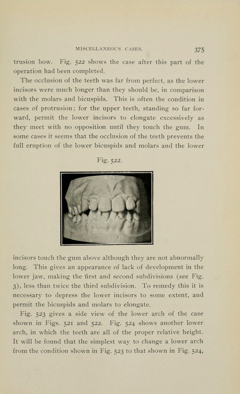 trusion bow. Fig. 522 shows the case after this part of the operation had been completed. The occlusion of the teeth was far from perfect, as the lower incisors were much longer than they should be. in comparison with the molars and bicuspids. This is often the condition in cases of protrusion ; for the upper teeth, standing so far for- ward, permit the lower incisors to elongate excessively as they meet with no opposition until they touch the gum. In some cases it seems that the occlusion of the teeth prevents the full eruption of the lower bicuspids and molars and the lower Fig. 522. incisors touch the gum above although they are not abnormally long. This gives an appearance of lack of development in the lower jaw. making the first and second subdivisions (see Fig. 3), less than twice the third subdivision. To remedy this it is necessary to depress the lower incisors to some extent, and permit the bicuspids and molars to elongate. Fig. 523 gives a side view of the lower arch of the case shown in Figs. 521 and 522. Fig. 524 shows another lower arch, in which the teeth are all of the proper relative height. It will be found that the simplest way to change a lower arch from the condition shown in Fig. 523 to that shown in Fig. 524,