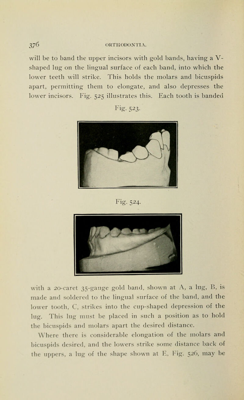 will be to band the upper incisors with gold bands, having a V- shaped lug on the lingual surface of each band, into which the lower teeth will strike. This holds the molars and bicuspids apart, permitting them to elongate, and also depresses the lower incisors. Fig. 525 illustrates this. Each tooth is banded Fig- 523- Fig. 524. with a 20-carel 35-gauge gold baud, shown at A, a lug, P>. is made and soldered to the lingual surface of the band, and the lower tooth, C, strikes into the cup-shaped depression of the lug. This lug must be placed in such a position as to hold the bicuspids and molars apart the desired distance. Where there is considerable elongation of the molars and bicuspids desired, and the lowers strike some distance back of the uppers, a lug of the shape shown at E, Fig. 520. may be: