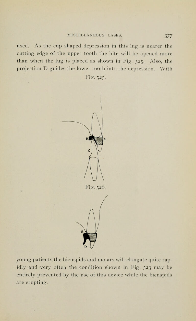 used. As the cup shaped depression in this lug is nearer the cutting edge of the upper tooth the l>ite will be opened more than when the lug is placed as shown in Fig. 525. Also, the projection 1) guides the lower tooth into the depression. With Fig- S2S- Fig. 526. young patients the bicuspids and molars will elongate quite rap- idly and very often the condition shown in Fig. 523 may he entirely prevented by the use of this device while the bicuspids are erupting.