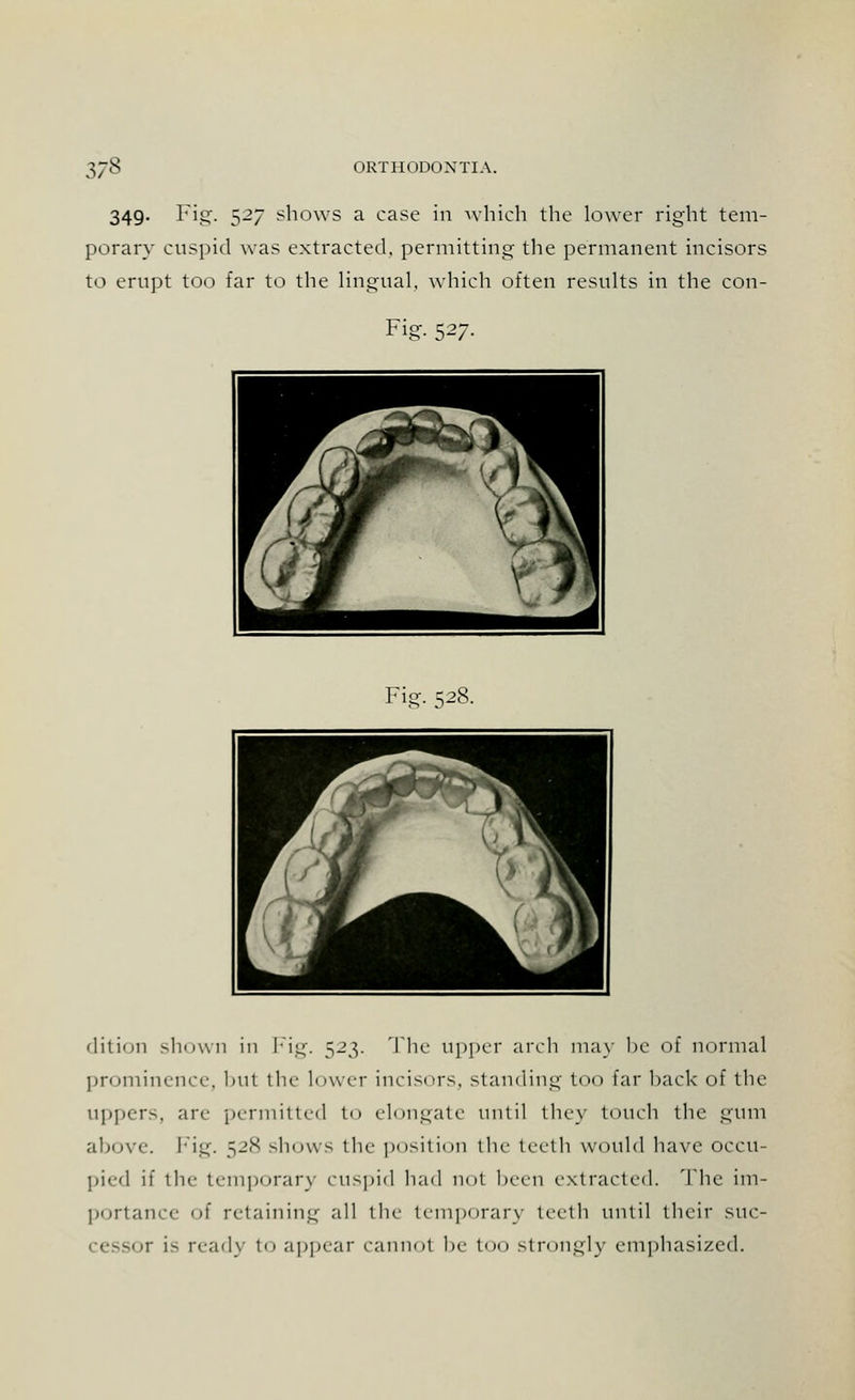 349. Fig. 527 shows a case in which the lower right tem- porary cuspid was extracted, permitting the permanent incisors to erupt too far to the lingual, which often results in the con- Fig. 527. Fie. ^28. dition shown in Fig. 523. The upper arch may be of normal prominence, hut the lower incisors, standing too Ear back of the uppers, arc permitted to elongate until they touch the gum above. Fig. 528 shows the position the teeth would have occu- pied if the temporary cuspid had not been extracted. The im- portance of retaining all the temporary teeth until their suc- r is ready to appear cannot be too strongly emphasized.