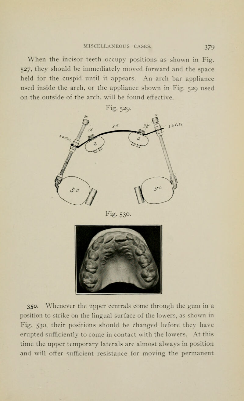 When the incisor teeth occupy positions as shown in Fig. $2y. they should be immediately moved forward and the space held for the cuspid until it appears. An arch har appliance used inside the arch, or the appliance shown in Fig. 529 used on the outside of the arch, will be found effective. Fig. 529. Fig. 530. 350. Whenever the upper centrals come through the gum in a position to strike on the lingual surface of the lowers, as shown in Fig. 530. their positions should be changed before they have erupted sufficiently to come in contact with the lowers. At this time the upper temporary laterals are almost always in position and will otter sufficient resistance for moving the permanent