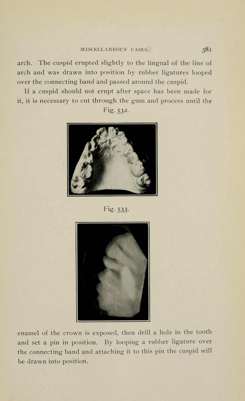 arch. The cuspid erupted slightly to the lingual of the line of arch and was drawn into position by rubber ligatures looped over the connecting band and passed around the cuspid. If a cuspid should not erupt after space has been made for it, it is necessary to cut through the gum and process until the I7i£- 532- W  x V 1£ <y I * 4 Fig- 533- enamel of the crown is exposed, then drill a hole in the tooth and set a pin in position. By looping a rubber ligature over the connecting band and attaching it to this pin the cuspid will be drawn into position.