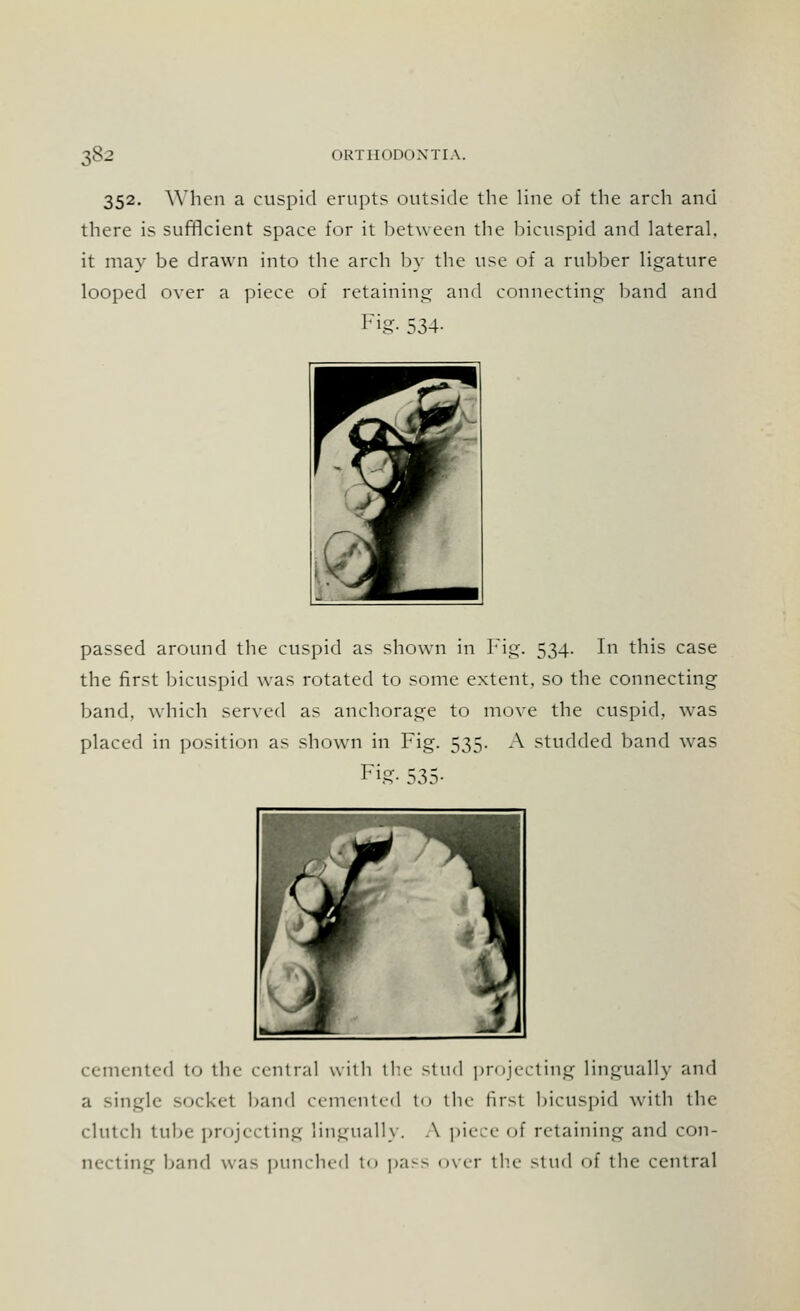 352. When a cuspid erupts outside the line of the arch and there is sufficient space for it between the bicuspid and lateral. it may be drawn into the arch by the use of a rubber ligature looped over a piece of retaining and connecting band and Fig- 534- passed around the cuspid as shown in Fig. 534. In this case the first bicuspid was rotated to some extent, so the connecting band, which served as anchorage to move the cuspid, was placed in position as shown in Fig. 535. A studded band was FiS- 535- cemented to the central with the stud projecting lingually and a single socket band cemented to the first bicuspid with the clutch tube projecting lingually. A piece of retaining and con- necting band was punched t<> pass over the stud of the central