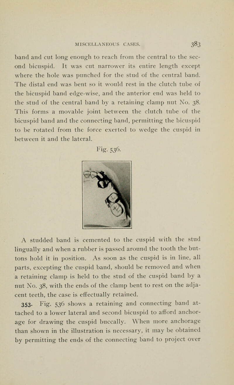 band and cut long enough to reach from the central to the sec- ond bicuspid. It was cut narrower its entire length excepl where the hole was punched for the stud of the central hand. The distal end was bent so it would rest in the clutch tube of the bicuspid hand edge-wise, and the anterior end was held to the stud of the central hand by a retaining clamp nut No. 38. This forms a movable joint between the clutch tube of the bicuspid band and the connecting band, permitting the bicuspid to be rotated from the force exerted to wedge the cuspid in between it and the lateral. Fig- 536- A studded band is cemented to the cuspid with the stud lingually and when a rubber is passed around the tooth the but- tons hold it in position. As soon as the cuspid is in line, all parts, excepting the cuspid band, should be removed and when a retaining clamp is held to the stud of the cuspid band by a nut No. 38, with the ends of the clamp bent to rest on the adja- cent teeth, the case is effectually retained. 353- Fig. 536 shows a retaining and connecting band at- tached to a lower lateral and second bicuspid to afford anchor- age for drawing the cuspid buccally. When more anchorage than shown in the illustration is necessary, it may be obtained by permitting the ends of the connecting band to project over