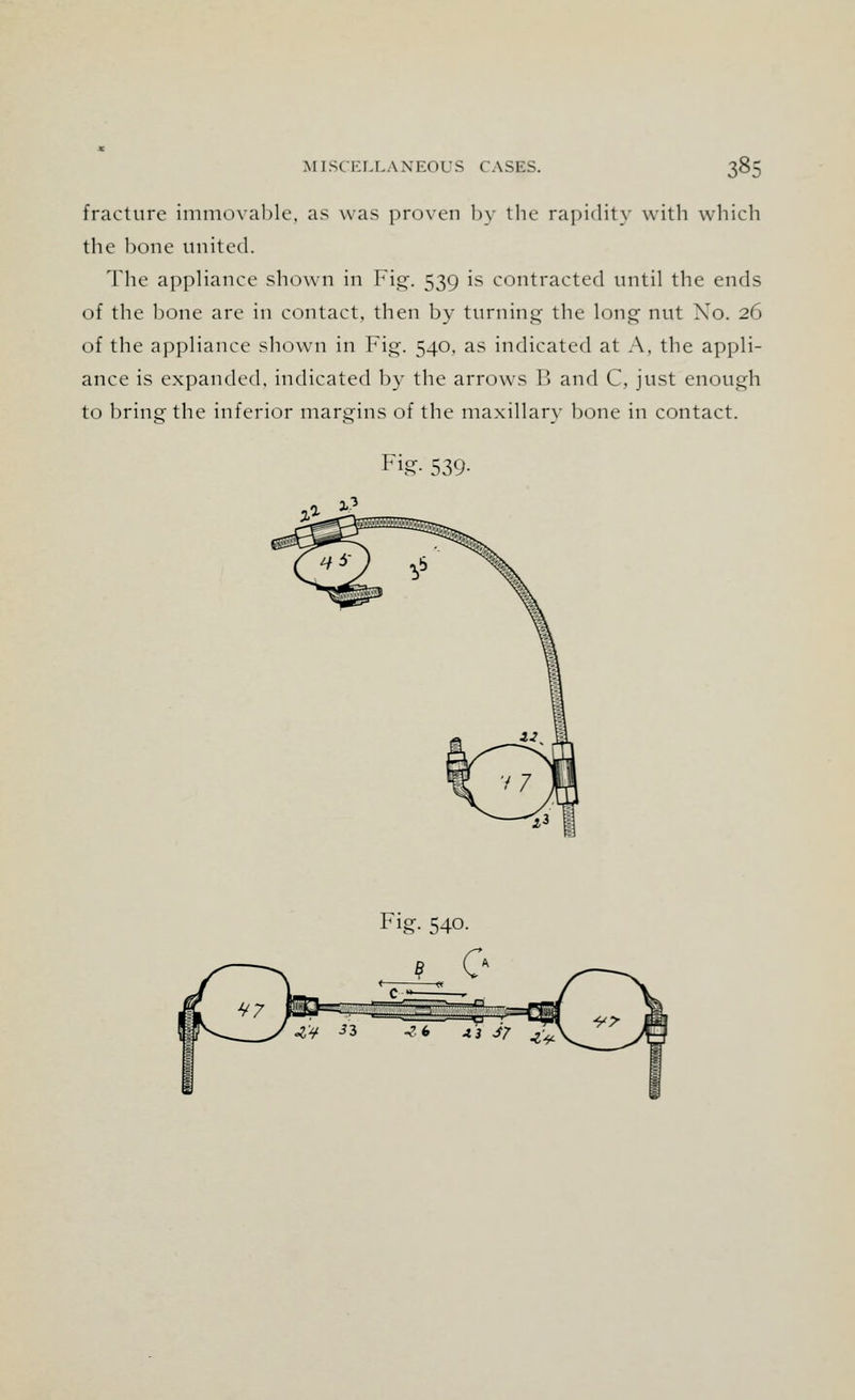 fracture immovable, as was proven by the rapidity with which the bone united. The appliance shown in Fig. 539 is contracted until the ends of the bone are in contact, then by turning the long nut Xo. 26 of the appliance shown in Fig. 540, as indicated at A, the appli- ance is expanded, indicated by the arrows R and C, just enough to bring the inferior margins of the maxillary bone in contact. Fig- 539- Fig. 540.