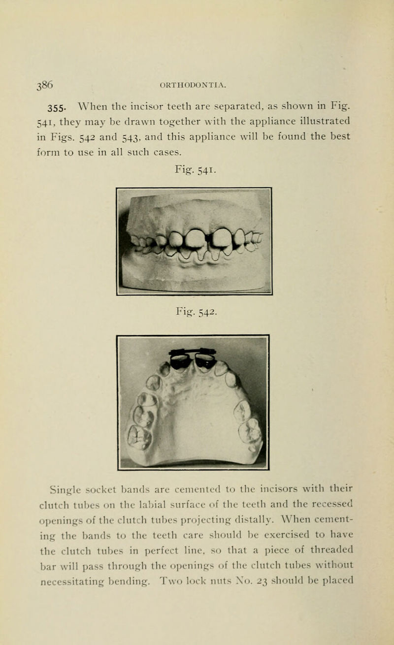 355- When the incisor teeth are separated, as shown in Fig. 541. they may be drawn together with the appliance illustrated in Figs. 542 and 543, and this appliance will be found the best form to use in all such cases. Fig-. 541. Fig. 542. Single- socket bands are cemented to the incisors with their clutch tubes ii the labial surface of the teeth and the rec< openings of the cluti h tubes pn ijecting distally. When cement- ing the bands to the teeth care should be exercised to have the clinch tubes in perfect line, so that a piece of threaded bar will pass through the openings of the clutch tubes without 3sitating bending. Two lock nuts No. 23 should be placed