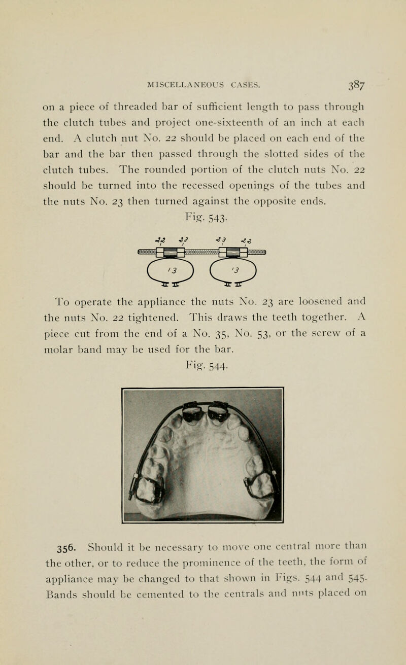 on a piece of threaded bar of sufficient length to pass through the clutch tubes and project one-sixteenth of an inch at each end. A clutch nut No. 22 should be placed on each end of the har and the bar then passed through the slotted sides of the clutch tubes. The rounded portion of the clutch nuts No. 22 should be turned into the recessed openings of the tubes and the nuts No. 23 then turned against the opposite ends. I7i.GT- 543- teHBfflMfflfflJ To operate the appliance the nuts No. 23 are loosened and the nuts No. 22 tightened. This draws the teeth together. A piece cut from the end of a No. 35. No. 53, or the screw of a molar band may be used for the bar. Fig. 544- 356. Should it be necessary to move one central more than the other, or to reduce the prominence of the teeth, the form of appliance may be changed to that shown in Figs. 544 and 545. Bands should be cemented to the centrals and nuts placed on