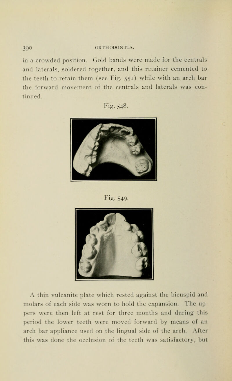 in a crowded position. Gold bands were made for the centrals and laterals, soldered together, and this retainer cemented to the teeth to retain them (see Fig. 551 ) while with an arch bar the forward movement of the centrals and laterals was con- tinned. Fig. 54*. Fig- 549- A thin vulcanite plate which rested against the bicuspid and molars of each side was worn to hold the expansion. The up- pers wire then left at rest for three months and during this period the lower teeth were moved forward by means of an arch bar appliance used on the lingual side of the arch, \iter this was done the occlusion of tin- teeth was satisfactory, but