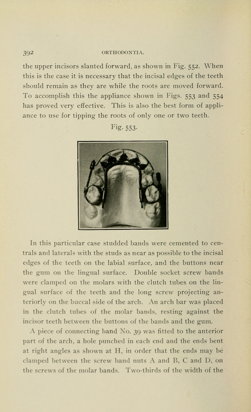 the upper incisors slanted forward, as shown in Fig. 552. When this is the case it is necessary that the incisal edges of the teeth should remain as they are while the roots are moved forward. To accomplish this the appliance shown in Figs. 553 and 554 has proved very effective. This is also the best form of appli- ance to use for tipping the roots of only one or two teeth. Fig- 553- In this particular case studded bands were cemented to cen- trals and laterals with the studs as near as possible to the incisal edges of the teeth on the labial surface, and the buttons near the gum on the lingual surface. Double socket screw bands wire clamped on the molars with the clutch tubes on the lin- gual surface of the teeth and the long screw projecting an- teriorly on the buccal side of tbe arch. An arch bar was placed in the clutch tubes of the molar bands, resting against the incisor teeth between the buttons of the bands and the gum. A piece of connecting band No. 39 was fitted to tbc anterior part of the arch, a hole punched in each end and the ends bent at right angles as shown at II. in order that the ends may be clamped between the screw band nuts A and B, C and ]), on the -'Tew- of the molar bands. Two-thirds of the width of tbe
