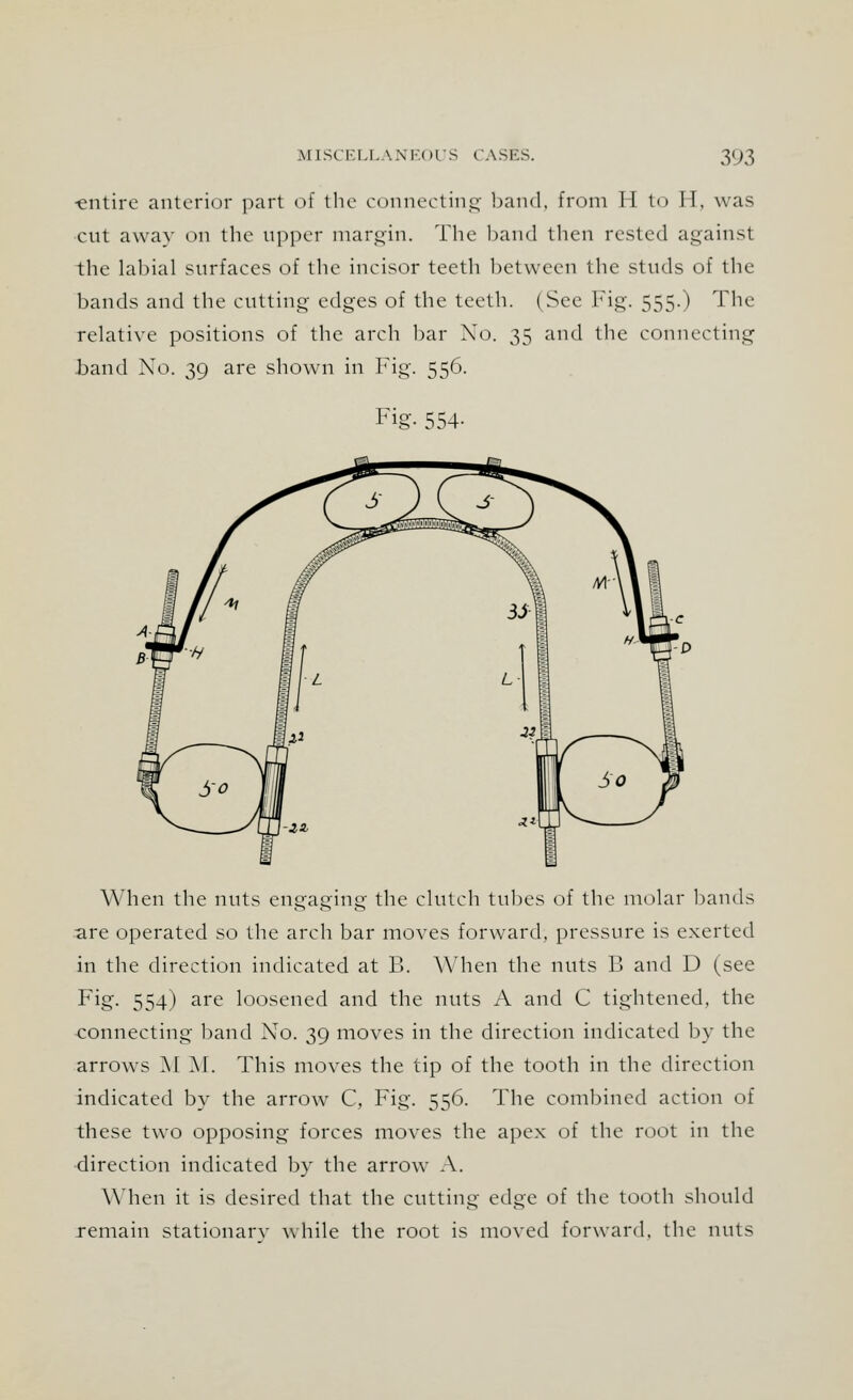 ■entire anterior part of the connecting hand, from H to II, was cut awav on the upper margin. The band then rested against the labial surfaces of the incisor teeth between the studs of the bands and the cutting edges of the teeth. (See Fig. 555.) The relative positions of the arch bar No. 35 and the connecting band No. 39 are shown in Fig. 556. Fig- 554- When the nuts engaging the clutch tubes of the molar hands are operated so the arch bar moves forward, pressure is exerted in the direction indicated at B. When the nuts B and D (see Fig. 554) are loosened and the nuts A and C tightened, the connecting band No. 39 moves in the direction indicated by the arrows MM. This moves the tip of the tooth in the direction indicated by the arrow C, Fig. 556. The combined action of these two opposing forces moves the apex of the root in the direction indicated by the arrow A. When it is desired that the cutting edge of the tooth should remain stationarv while the root is moved forward, the nuts