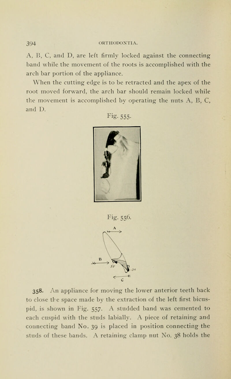 A. B, C, and D, are left firmly locked against the connecting band while the movement of the roots is accomplished with the arch bar portion of the appliance. When the cutting edge is to be retracted and the apex of the root moved forward, the arch bar should remain locked while the movement is accomplished by operating the nuts A, B, C, and D. Fig- 555- Fig- 556. 358. An appliance for moving the lower anterior teeth back to close the space made by the extraction of the left first bicus- pid, is shown in Fig. 557. A studded band was cemented to each cuspid with the studs labially. A piece of retaining and connecting band No. 39 is placed in position connecting the studs of these band-. A retaining clamp nut No. 38 holds the