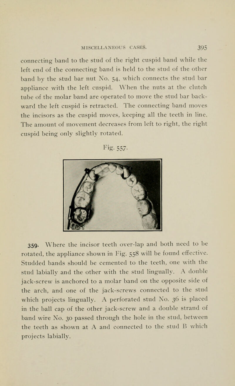 connecting band to the stud of the right cuspid band while the left end of the connecting band is held to the stud of the other band by the stud bar nut No. 54, which connects the stud bar appliance with the left cuspid. When the nuts at the clutch tube of the molar hand are operated to move the stud liar hack- ward the left cuspid is retracted. The connecting hand moves the incisors as the cuspid moves, keeping- all the teeth in line. The amount of movement decreases from left to right, the right cuspid being' only slightly rotated. Fig'- 557- 359. Where the incisor teeth over-lap and both need to be rotated, the appliance shown in Fig. 558 will be found effective. Studded bands should be cemented to the teeth, one with the stud labially and the other with the stud lingually. A double jack-screw is anchored to a molar band on the opposite side of the arch, and one of the jack-screws connected to the stud which projects lingually. A perforated stud No. 36 is placed in the ball cap of the other jack-screw and a double strand of band wire Xo. 30 passed through the hole in the stud, between the teeth as shown at A and connected to the stud B which projects labially.