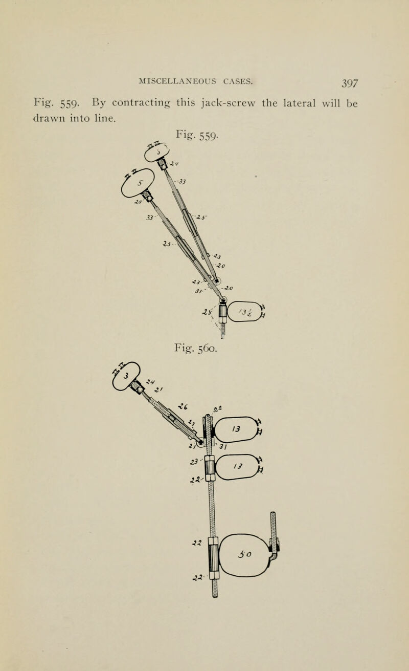 MISCKLLAXl'.nrS CASKS. W7 Fig. 559. By contracting this jack-screw the lateral will be drawn into line. fig- 559-