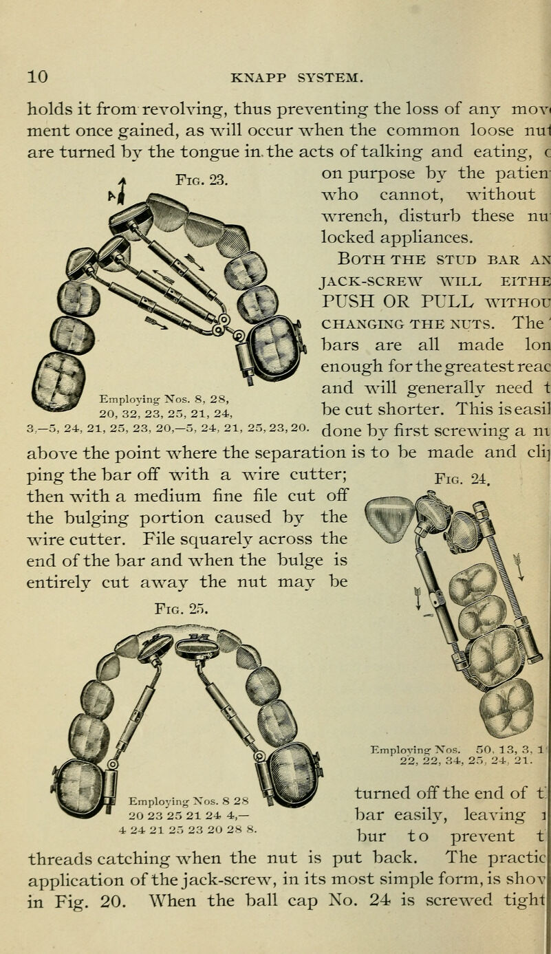 Fig. 23. holds it from revolving, thus preventing the loss of any mov ment once gained, as v.411 occur Avhen the common loose nui are turned by the tongue in. the acts of talking and eating, c on purpose by the patien ^^ho cannot, without ^kvrench, disturb these nu locked appliances. Both the stud bar an jack-screw will eithe PUSH OR PULL waTHou CHANGING THE NUTS. The ' bars are all made Ion enough for the greatest reac and will generally need i be cut shorter. This iseasil done by first scre^ng a ni above the point ^where the separation is to be made and clij ping the bar off ^th a v.nre cutter; then \vith a medium fine file cut off the bulging portion caused by the Avire cutter. File squarely across the end of the bar and v^hen the bulge is entirely cut a-wsij the nut may be Fig. 25. Employing Nos. 8, 28, 20, 32, 23, 25, 21, 24, 3,-5, 24, 21, 25, 23, 20,-5, 24, 21, 25, 23, 20 Fig Emploving-Xos. 50, 13, 3, 1 22, 22, 34, 25, 24, 21. turned off the end of t bar easily, leaving i bur to prevent t threads catching when the nut is put back. The practic application of the jack-screw, in its most simple form, is shoT in Fig. 20. When the ball cap No. 24 is screwed tight Employing Xos. 8 28 20 23 25 21 24 4,— 4 24 21 25 23 20 28 8.