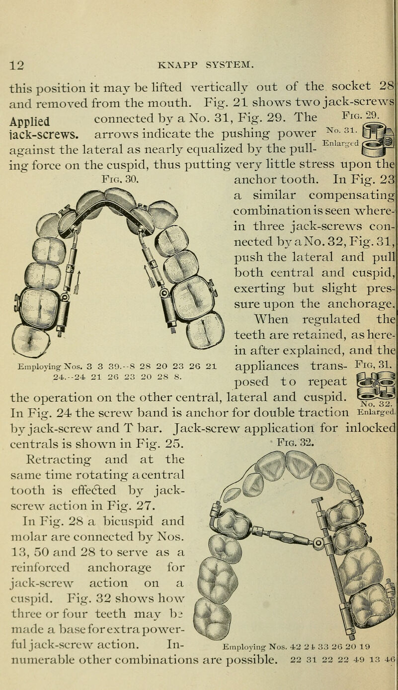 this position it may be lifted vertically out of the socket 28 and removed from the mouth. Fig. 21 shows two jack-screws Applied connected by a No. 31, Fig. 29. The Fig. 29. jack-screws, arrows indicate the pushing power against the lateral as nearly equalized by the pull- ing force on the cuspid, thus putting very little stress upon the Fig. 30. anchor tooth. In Fig. 23 a similar compensating combination is seen v^here- in three jack-scre^ws con- nected by aNo. 32, Fig. 31, push the lateral and pull both central and cuspid, exerting but slight pres- sure upon the anchorage. When regulated the teeth are retained, as here- in after explained, and the appliances trans- Fig, 31, posed t o repeat the operation on the other central, lateral and cuspid. ^ In Fig. 24 the screw band is anchor for double traction Enlarged. by jack-screw and T bar. Jack-scre^v application for inlocked centrals is shov^n in Fig. 25. Fig. 32. Retracting and at the same time rotating a central tooth is effedled by jack- vScrew action in Fig. 27. In Fig. 28 a bicuspid and molar are connected by Nos. 13, 50 and 28 to serve as a reinforced anchorage for jack-screw action on a cuspid. Fig. 32 sho^vs how three or four teeth may bj made a base for extra po^wer- ful jack-screw action. In- numerable other combinations are possible. 22 31 22 22 49 13 46 Employing-Nos. 3 3 39.--8 28 20 23 26 21 24.--24 21 26 23 20 28 8. Employing Nos. 42 2 t 33 26 20 19