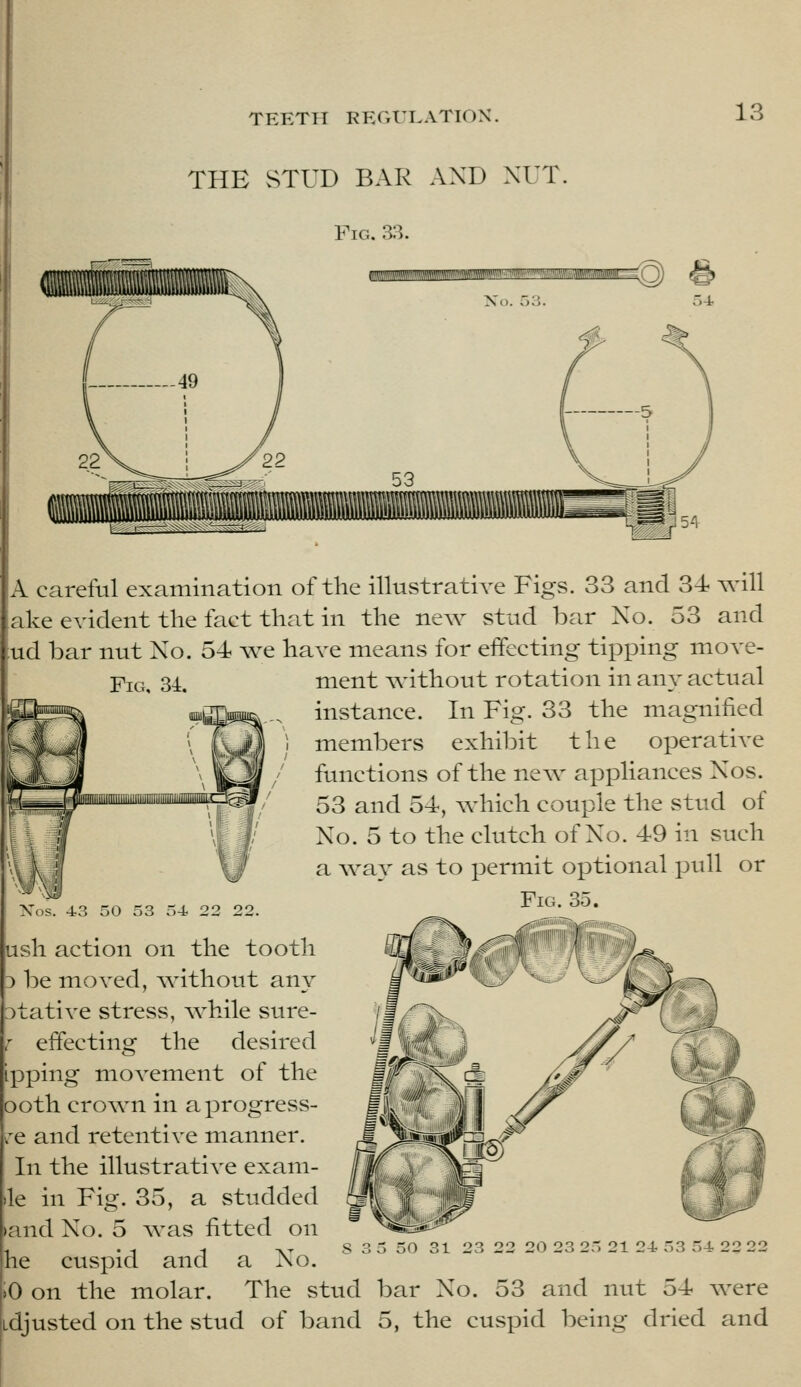 THE vSTUD BAR AND .XUT. Fig. 33. A careful examination of the illustrative Figs. 33 and 34 will ake evident the fact that in the new stud bar No. 53 and ud bar nut No. 54 we have means for effecting tipping move- FiG, 3i. Xos. 43 50 53 54 22 22. ush action on the tooth 3 be moved, v^nthout any 3tative stress, Avhile sure- the desired ment without rotation in any actual instance. In Fig. 33 the magnified members exhibit the operative functions of the new appliances Nos. 53 and 54, which couple the stud of No. 5 to the clutch of No. 49 in such a way as to permit optional pidl or Fig. 35. effecting ippm Of movement of the ooth crown in a progress- re and retentive manner. In the illustrative exam- le in Fig. 35, a studded >and No. 5 v^^as fitted on he cuspid and a No. 0 on the molar. The stud bar No. 53 and nut 54 were Ldjusted on the stud of band 5, the cuspid being dried and 5 50 31 23 22 20 23 25 21 24 53 54 22 22