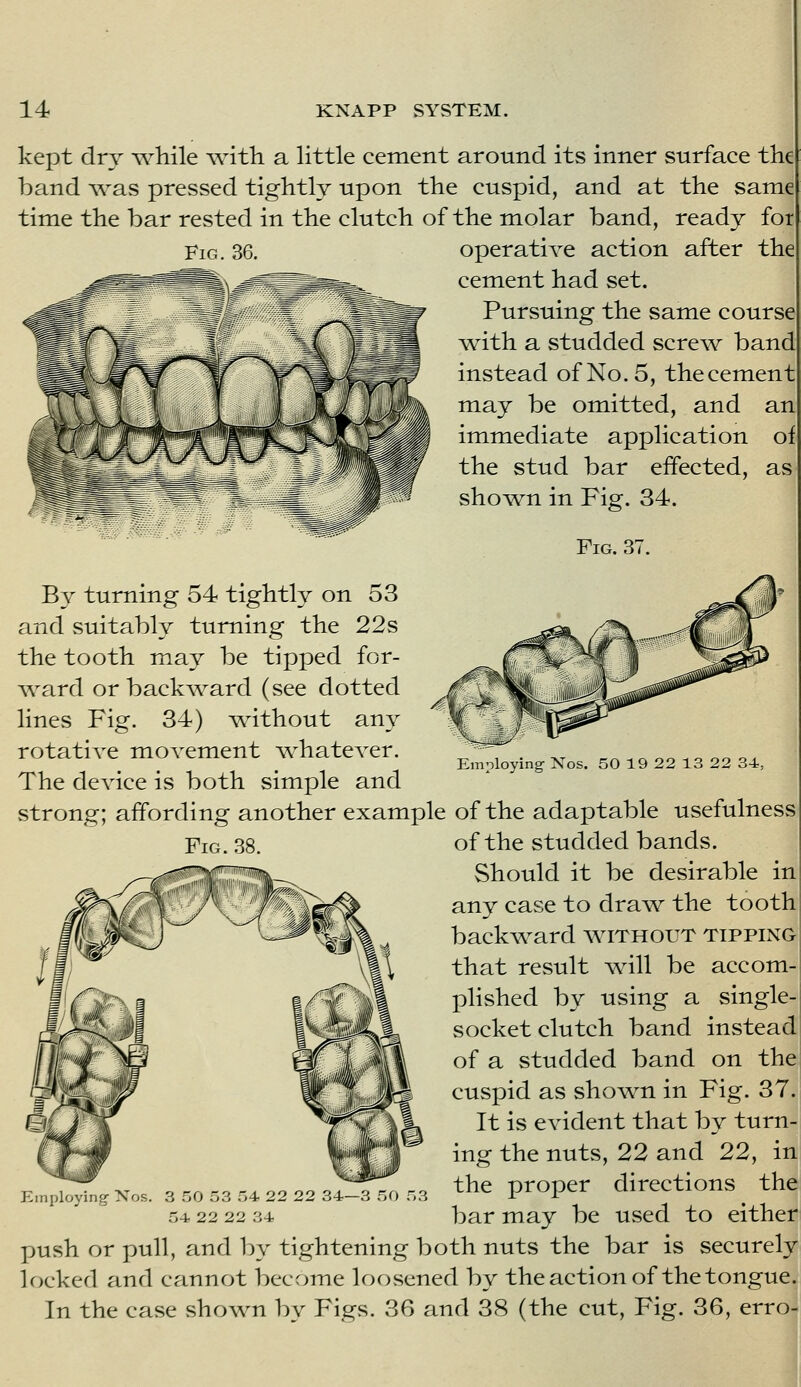 kept dr^ while with a Httle cement around its inner surface the hand \vas pressed tightly upon the cuspid, and at the same time the bar rested in the clutch of the molar band, ready for Fig. 36. operative action after the cement had set. Pursuing the same course with a studded screw band instead of No. 5, the cement may be omitted, and an immediate application oi the stud bar effected, as sho^wn in Fig. 34. Fig. 37. By turning 54 tightly on 53 and suitably turning the 22s the tooth may be tipped for- ^vard or backward (see dotted lines Fig. 34) ^thout any rotative movement ^whatever. The device is both simple and strong; affording another example of the adaptable usefulness of the studded bands. Should it be desirable in any case to draw the tooth backward without tipping that result will be accom- plished by using a single- socket clutch band instead of a studded band on thej cuspid as shown in Fig. 37. It is evident that by turn- ing the nuts, 22 and 22, in 3 ^^^^ ^,, the proper directions the bar may be used to either push or pull, and by tightening both nuts the bar is securely locked and cannot become loosened by the action of the tongue. In the case shown by Figs. 36 and 38 (the cut. Fig. 36, erro- Employing- Nos. 50 19 22 13 22 34, E Xos. 3 no 53 54 22 22 34- 54 22 22 34