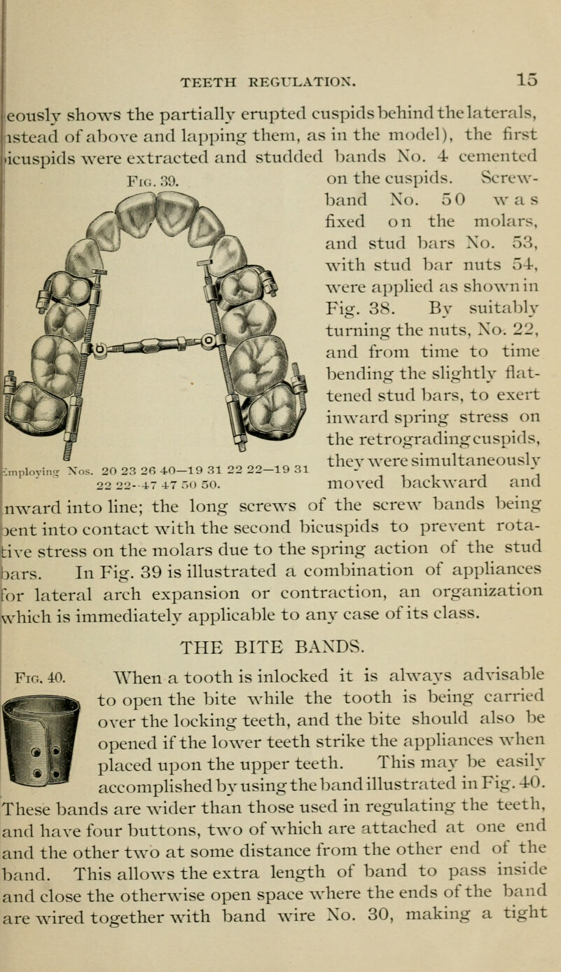 Fig. 39. eotisly shows the partially crtipted cuspids behind the laterals, istead of above and lappinu; them, as in the model), the first icuspids were extracted and studded bands No. 4 cemented on the cuspids. Screw- band No. 50 \Y a s fixed on the molars, and stud bars No. 53, with stud bar nuts 54-, were applied as shown in Fig. 38. By suitably turning the nuts. No. 22, and from time to time bending the slightly flat- tened stud bars, to exeii; inward spring stress on the retrograding cuspids, thev were simultaneoush' moved backward and nward into line; the long screws of the screw bands being 3ent into contact with the second bicuspids to prevent rota- tive stress on the molars due to the spring action of the stud bars. In Fig. 39 is illustrated a combination of apphances For lateral arch expansion or contraction, an organization which is immediately applicable to any case of its class. ^ Cniployin- Xos. 20 23 2R 40—19 31 22 22—19 31 22 22--47 47 .(J 50. THE BITE BANDS. Fig. 40. When a tooth is inlocked it is always advisable to open the bite while the tooth is being carried over the locking teeth, and the bite should also be opened if the lower teeth strike the appliances when placed upon the upper teeth. This may be easily accomphshed by using the band illustrated in Fig. 40. These bands are wider than those used in regulating the teeth, and have four buttons, two of which are attached at one end and the other two at some distance from the other end of the band. This allows the extra length of band to pass inside and close the otherwise open space where the ends of the band are wired together with band wire No. 30, making a tight