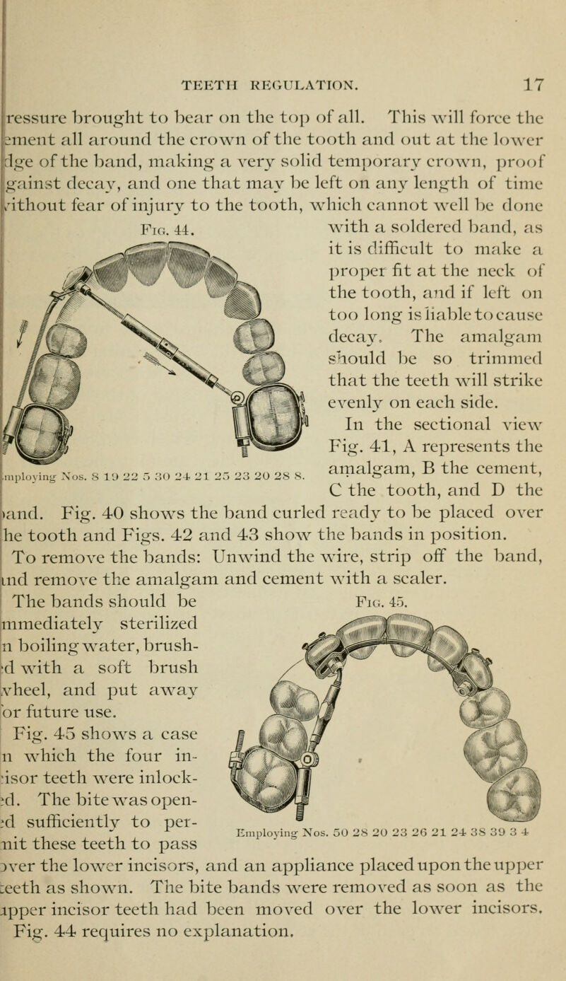 Xos. S I'J 22 -) :iO 24- 21 23 23 20 28 S. ressure brought to bear on the top of all. This will foree the sment all around the erown of the tooth and out at the lower dge of the band, making a very solid temporary crown, proof gainst decay, and one that may be left on any length of time nthout fear of injury to the tooth, which cannot well be done with a soldered band, as it is difficult to make a proper fit at the neck of the tooth, a?id if left on too long is liable to cause decay. The amalgam should be so trimmed that the teeth will strike evenly on each side. In the sectional view Fig. 41, A reprCvSents the amalgam, B the cement, C the tooth, and D the >and. Fig. 40 shows the band curled ready to be placed over he tooth and Figs. 42 and 43 show^ the bands in position. To remove the bands: Un\vind the wire, strip off the band, md remove the amalgam and cement with a scaler. The bands should be mmediately sterilized n boiling w^ater, brush- 'd v^4th a soft brush vheel, and put away or future use. Fig. 45 shows a case n Avhich the four in- cisor teeth Avere inlock- id. The bite was open- id sufficiently to per- mit these teeth to pass Dver the lower incisors, and an appliance placed upon the upper ceeth as showni. The bite bands were removed as soon as the ipper incisor teeth had been moved over the lo\ver incisors. Fig. 44 requires no explanation. Fig. 45. liinployiiig Nos. 50 28 20 23 26 21 24 38 o'J 3 4