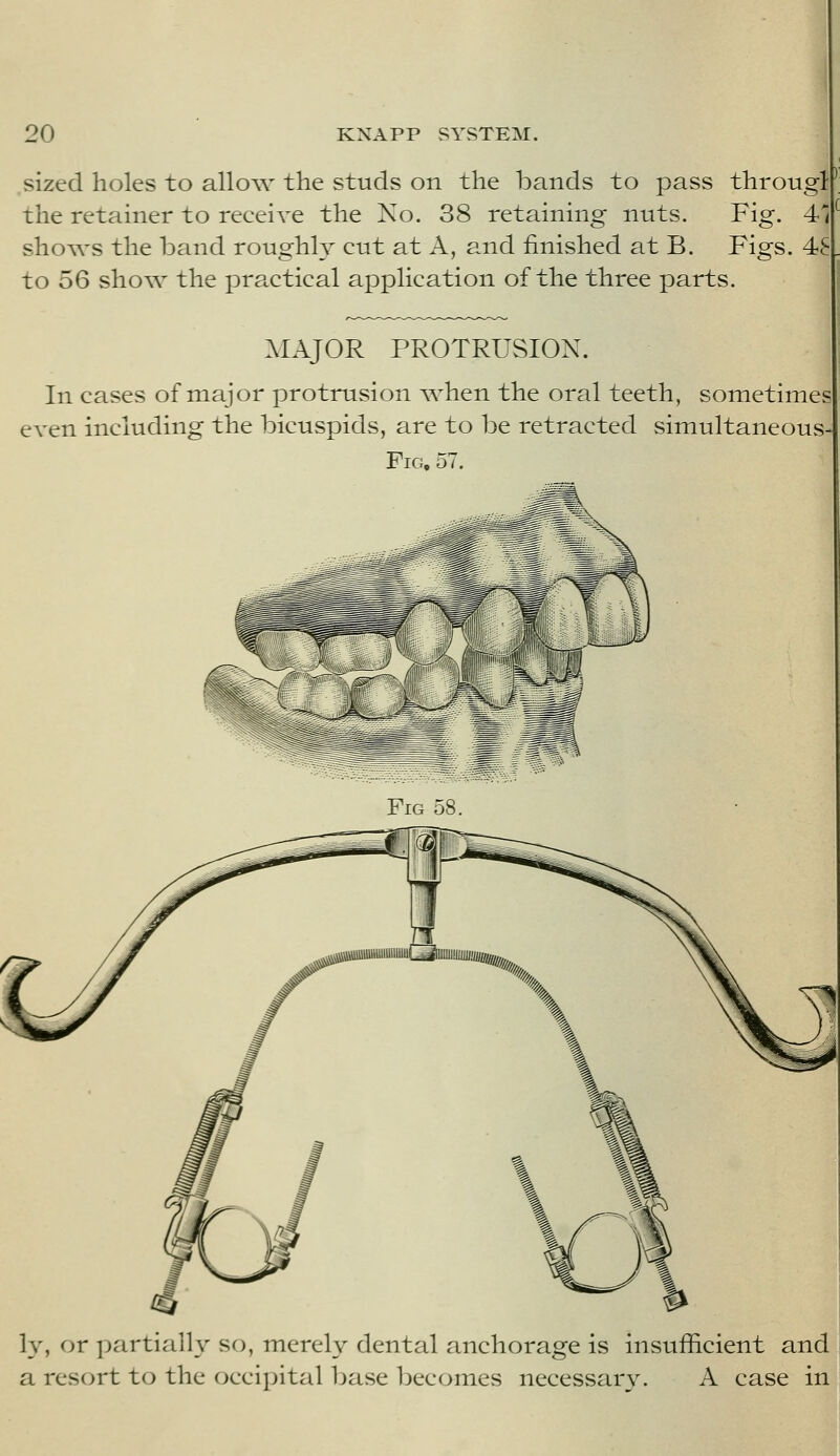sized holes to allo^v the studs on the bands to pass througl the retainer to receive the Ko. 38 retaining nuts. Fig. 41 sho\vs the band roughly cut at A, and finished at B. Figs. 4S to 56 show the practical application of the three parts. MAJOR PROTRUSION. In cases of major protrusion v^^hen the oral teeth, sometimes even including the bicuspids, are to be retracted simultaneous Fig, 57. Fig 58. ly, or partially so, merely dental anchorage is insufficient and a resort to the occipital base becomes necessary. A case in
