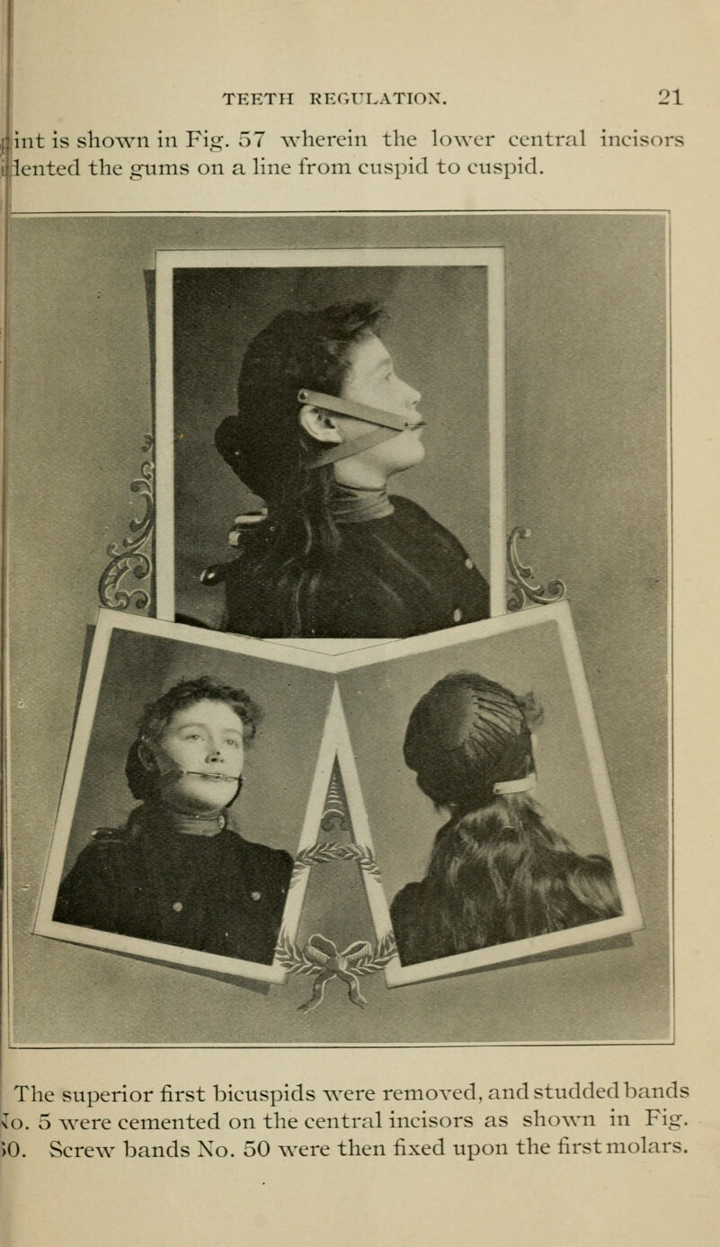 I lint is shown in Fig. 57 wherein the lower central incisors jiiented the gums on a line from cuspid to cuspid. The superior first bicuspids were removed, and studded bands \o. 5 were cemented on the central incisors as shown in Fig. )0. Screw bands Xo. 50 were then fixed upon the first molars. I