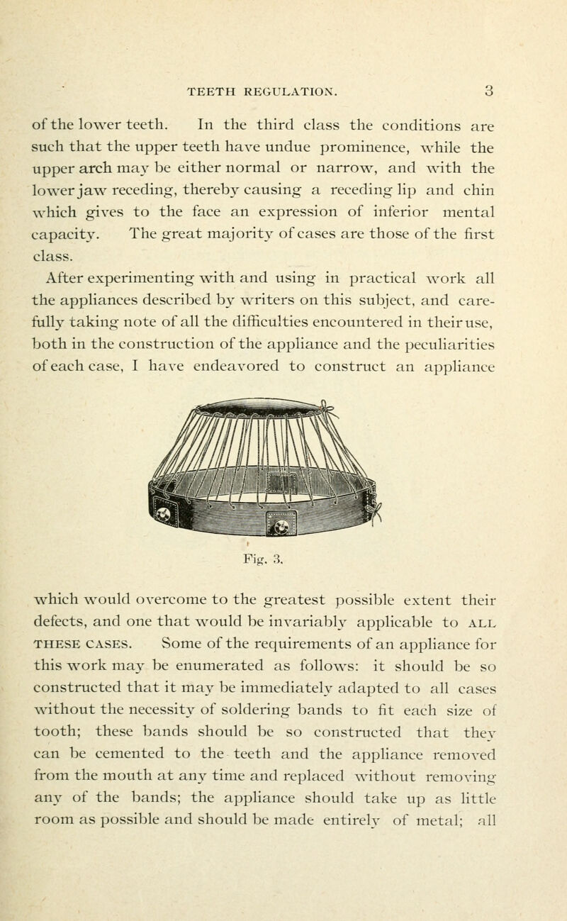 of the lower teeth. In the third class the conditions are such that the upper teeth have undue prominence, while the upper arch may be either normal or narrow^ and with the lower jaw receding, thereby causing a receding lip and chin which gives to the face an expression of inferior mental capacity. The great majority of cases are those of the first class. After experimenting with and using in practical work all the appliances described by writers on this subject, and care- fiiUy taking note of all the difficulties encountered in their use, both in the construction of the appliance and the peculiarities of each case, I have endeavored to construct an appliance Fig. 3. which would overcome to the greatest possible extent their defects, and one that would be invariably applicable to all THESE CASES. Some of the requirements of an appliance for this w^ork may be enumerated as follows: it should be so constructed that it may be immediately adapted to all cases without the necessity of soldering bands to fit each size of tooth; these bands should be so constructed that thev can be cemented to the teeth and the appliance removed from the mouth at any time and replaced without removing any of the bands; the appliance should take up as little room as possible and should be made entirely of metal; all