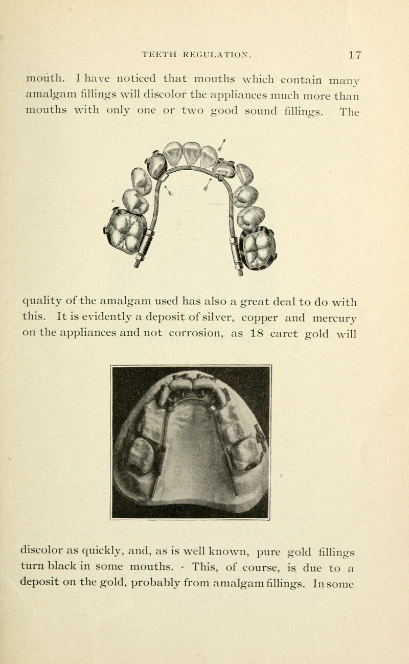 mouth. I have noticed that mouths which contain many amalgam filHngs will discolor the appliances much more than mouths with only one or two good sound filHngs. The quality of the amalgam used has also a great deal to do with this. It is evidently a deposit of silver, copper and mercury on the appliances and not corrosion, as 18 caret gold will discolor as quickly, and, as is well known, pure gold fillings turn black in some mouths. - This, of course, is due to a deposit on the gold, probably from amalgam fillings. In some