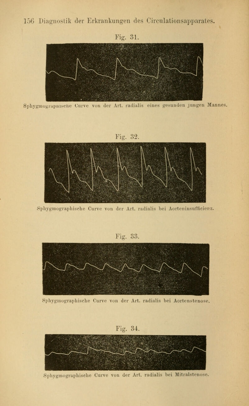 Fiff. 31. SpliygiHoj^nilJiiisclie Curve von der Art. radialis eines gesunden jungen Mannes. Sphyginographiselie Curve von der Art. radialis bei Aorteninsuffieienz. 12:. 06. Sidi^'ginograiihische Curve von der Art. radialis hei Aortenstenose. Fiff. 34. Sphygmographische Curve von der Art. radialis bei Mitralstenose.