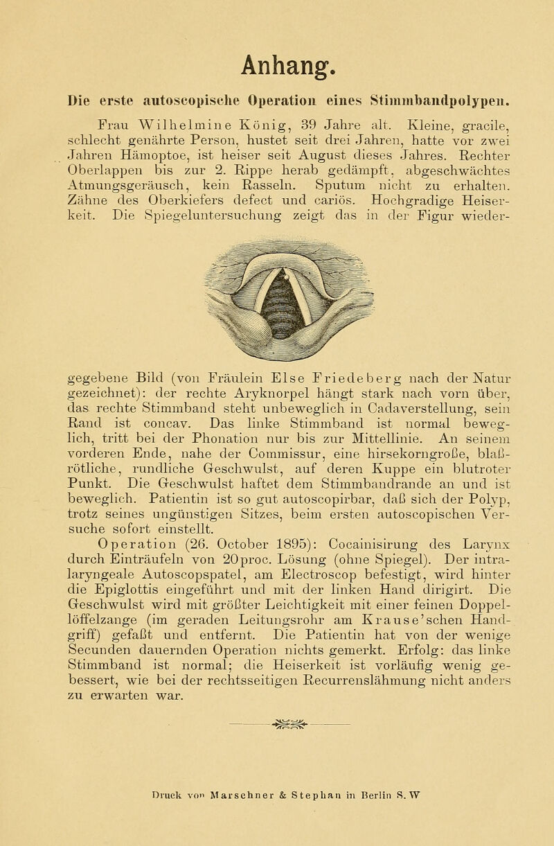Anhang. Die erste autoscopische Operation eines Stimmbandpolypeu. Frau Wilhelmine König, 39 Jahre alt. Kleine, gracile, schlecht genährte Person, hustet seit drei Jahren, hatte vor zwei Jahren Hämoptoe, ist heiser seit August dieses Jahres. Rechter Oberlappen bis zur 2. Rippe herab gedämpft, abgeschwächtes Atmungsgeräusch, kein Rasseln. Sputum nicht zu erhalten. Zähne des Oberkiefers defect und cariös. Hochgradige Heiser- keit. Die Spiegeluntersuchung zeigt das in der Figur wieder- gegebene Bild (von Fräulein Else Friede berg nach der Natur gezeichnet): der rechte Aryknorpel hängt stark nach vorn über, das rechte Stimmband steht unbeweglich in Cadaverstellung, sein Rand ist concav. Das linke Stimmband ist normal beweg- lich, tritt bei der Phonation nur bis zur Mittellinie. An seinem vorderen Ende, nahe der Commissur, eine hirsekorngroße, blaß- rötliche, rundliche Geschwulst, auf deren Kuppe ein blutroter Punkt. Die Geschwulst haftet dem Stimmbandrande an und ist beweglich. Patientin ist so gut autoscopirbar, daß sich der Polyp, trotz seines ungünstigen Sitzes, beim ersten autoscopischen Ver- suche sofort einstellt. Operation (26. October 1895): Cocainisirung des Larynx durch Einträufeln von 20proc. Lösung (ohne Spiegel). Der intra- laryngeale Autoscopspatel, am Electroscop befestigt, wird hinter die Epiglottis eingeführt und mit der linken Hand dirigirt. Die Geschwulst wird mit größter Leichtigkeit mit einer feinen Doppel- löffelzange (im geraden Leitungsrohr am Krause'sehen Hand- griff) gefaßt und entfernt. Die Patientin hat von der wenige Secunden dauernden Operation nichts gemerkt. Erfolg: das linke Stimmband ist normal; die Heiserkeit ist vorläufig wenig ge- bessert, wie bei der rechtsseitigen Recurrenslähmung nicht anders zu erwarten war.