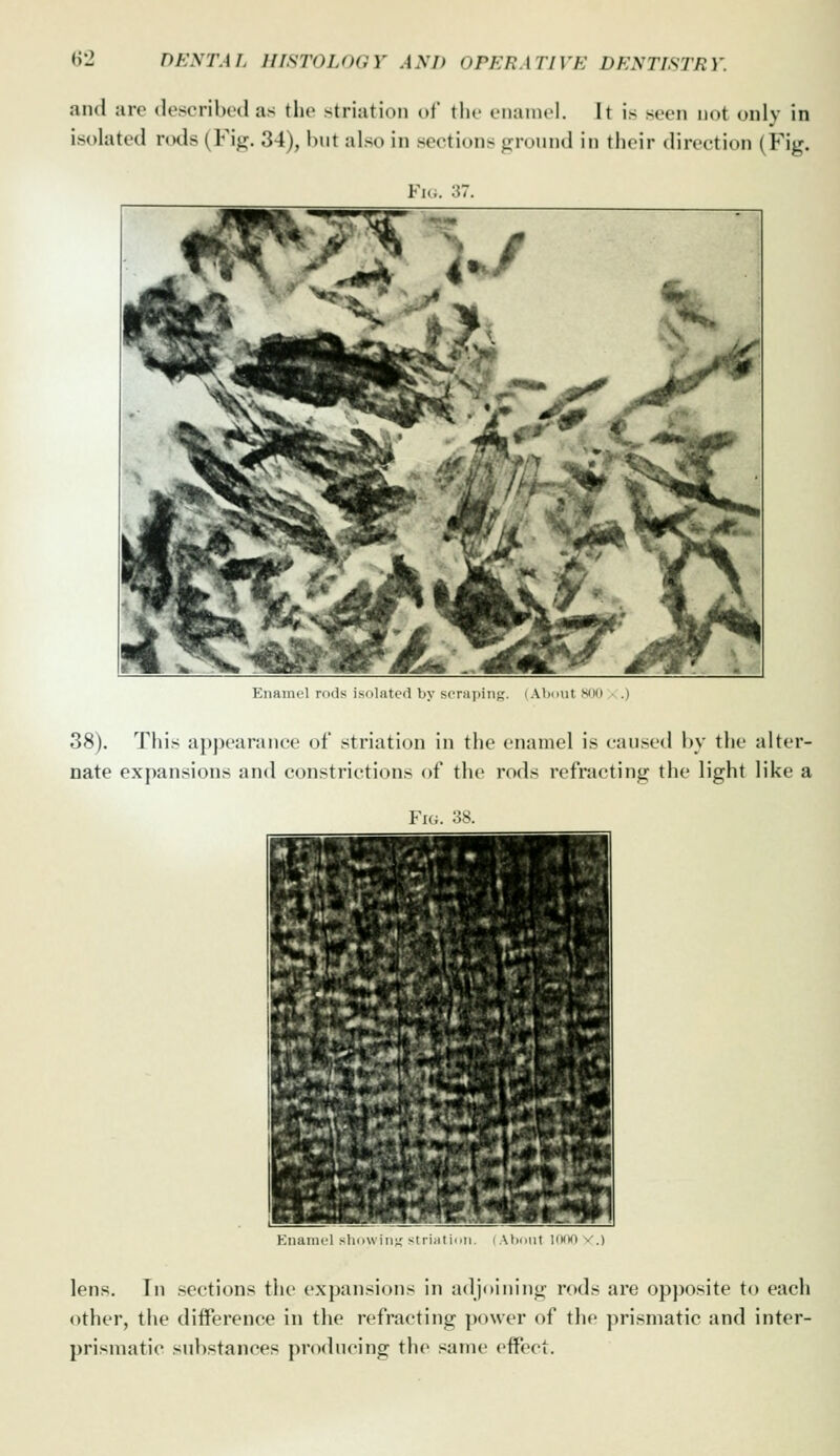 and are described as the striation of the fiuuncl. It is seen not only in isolated rods (Fig. 34), but also in sections ground in their direction (Fig. Fi... :{7. Enamel rods isolated by scraping. (About SUO a .) 38). This appearanw of striation in the enamel is caused by the alter- nate expansions and constrictions of the rods refracting the light like a Fu;. .'is. Enamel showing striation. (About IfniO v.) lens. In sections the expansions in adjoining rods are opposite to each other, the difference in the refracting power of the prismatic and inter- prismatic substances producing the same effect.