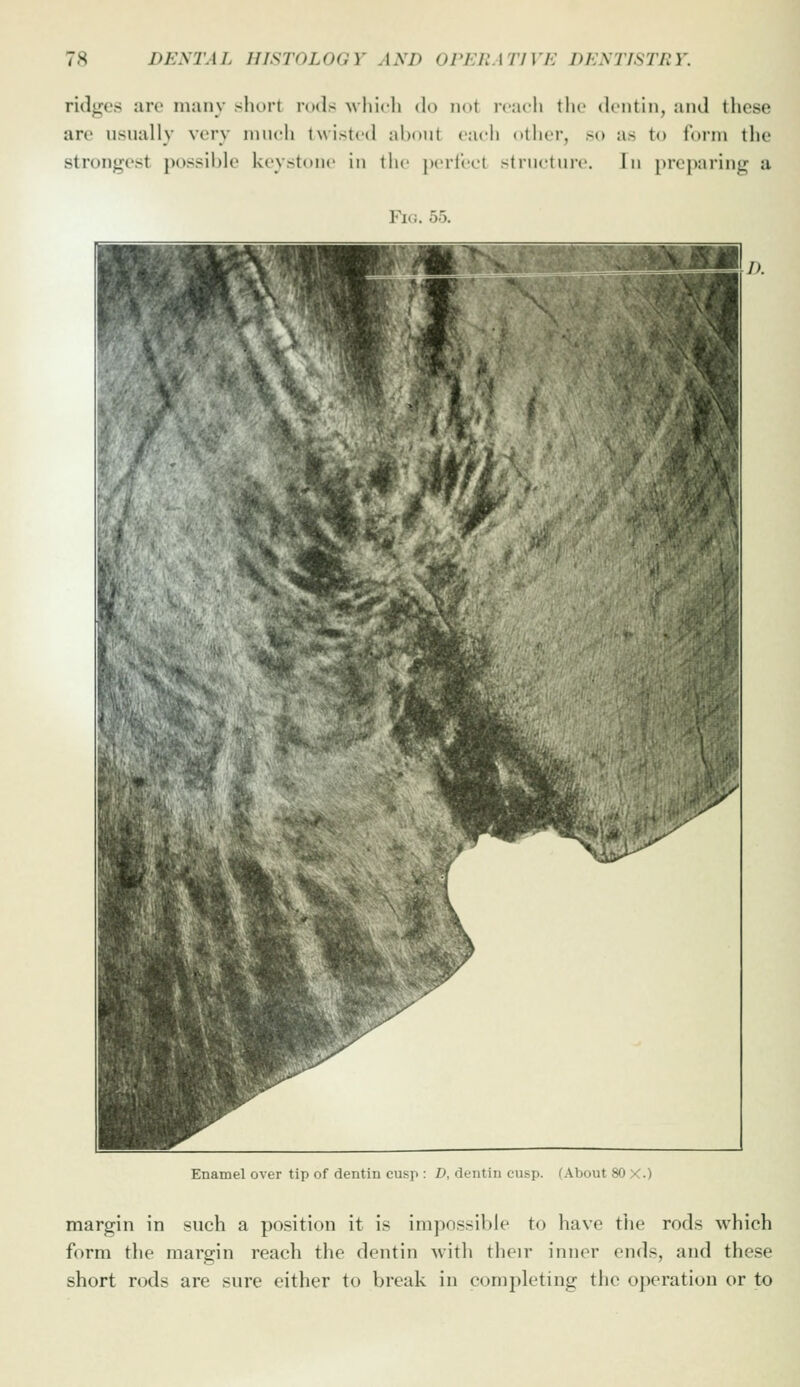 ridges are many short rods Avliidi do not icacli the dentin, and these are usually very much twisted about each otiier, so as to form the strongest possible keystone in the jieii'eet strnctnre. In preparing a Fi.;. o5. Enamel over tip of dentin cusp : D, dentin cusp, fAbout 80 X.) margin in such a position it is impossil)le to have the rods which form the margin reach the dentin with their inner ends, and these short rods are sure either to break in completing the operation or to