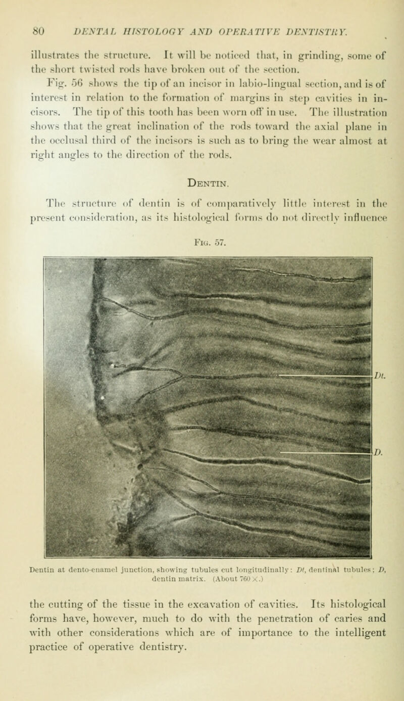 illustrates the structuro. It will bo noticed that, in grinding, some of the short twisted rods have broken out of the section. Fig. 56 shows the tip of an incisor in labio-lingual section, and is of interest in relation to the formation of margins in step cavities in in- cisors. The tip of this tooth has been worn off in use. The illustration shows that the great inclination of the rods toward the axial plane in the occlusal third of the incisors is such as to bring tiie wear almost at right angles to the direction of the rods. Dentin. The structure of dentin is of eom|»aratively little interest in the present consideration, as its histological forms do not diicetly iuHueuee Fig. 57. Dentin at dento-enamel junction, showing tubuk-s cut longitudinally: /y^ dentinftl ttibuli's : D, dentin matrix. (About 760 X.) the cutting of the tissue in the excavation of cavities. Its histological forms have, however, much to do with the penetration of caries and with other considerations which are of importance to the intelligent practice of operative dentistry.