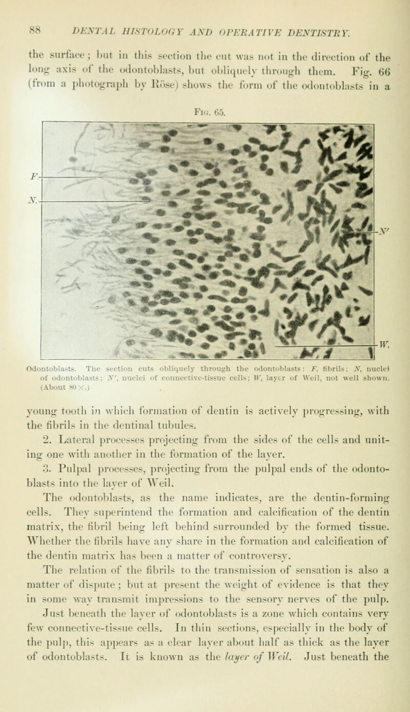 tlie surfacr ; hut in tliis s^vtion the cut was ii(»t in the diivctioii of the long axis of the odontobhists, but obliquely through them. Fig. 66 (from a photograph bv Kose) shows the form of the otlontoblasts in a Odontoblasts. The section cuts obliquely thrriu<;h the odontoblasts: /, fibrils: X, nuclei of odontoblasts; .V, nuclei of connective-tissue cells; )(', layer of Weil, not well shown. (About 80 X.) young tooth in which formation of dentin is actively progressing, with the fibrils in the dentinal lul)ules. 2. Lateral ])rocesses projecting from the sides of the cells and unit- ins: one with another in the formation of the laver. 3. Pulpal processes, projecting from the pulpal ends of the odonto- blasts into the layer of AVeil. The odontoblasts, as the name indicates, are the dentin-forming cells. They superintend the formation and calcification of the dentin matrix, the fibril being left behind surrounded by the formed tissue. Whether the fibrils have any share in the formation and calcification of the dentin matrix has been a matter of controversy. The relation of the fibrils to the transmission of sensation is also a matter of dispute ; but at present the weight of evidence is that they in some way transmit impressions to the sensory nerves of the pulp. Just beneath the layer of odontoblasts is a zone wliich contains very few connective-tissue cells. In thin sections, esjK'cially in the body of the pulj), this appears as a clear layer about half as thick as the layer of odontoblasts. It is known as the la^er of Weil. Just beneath the